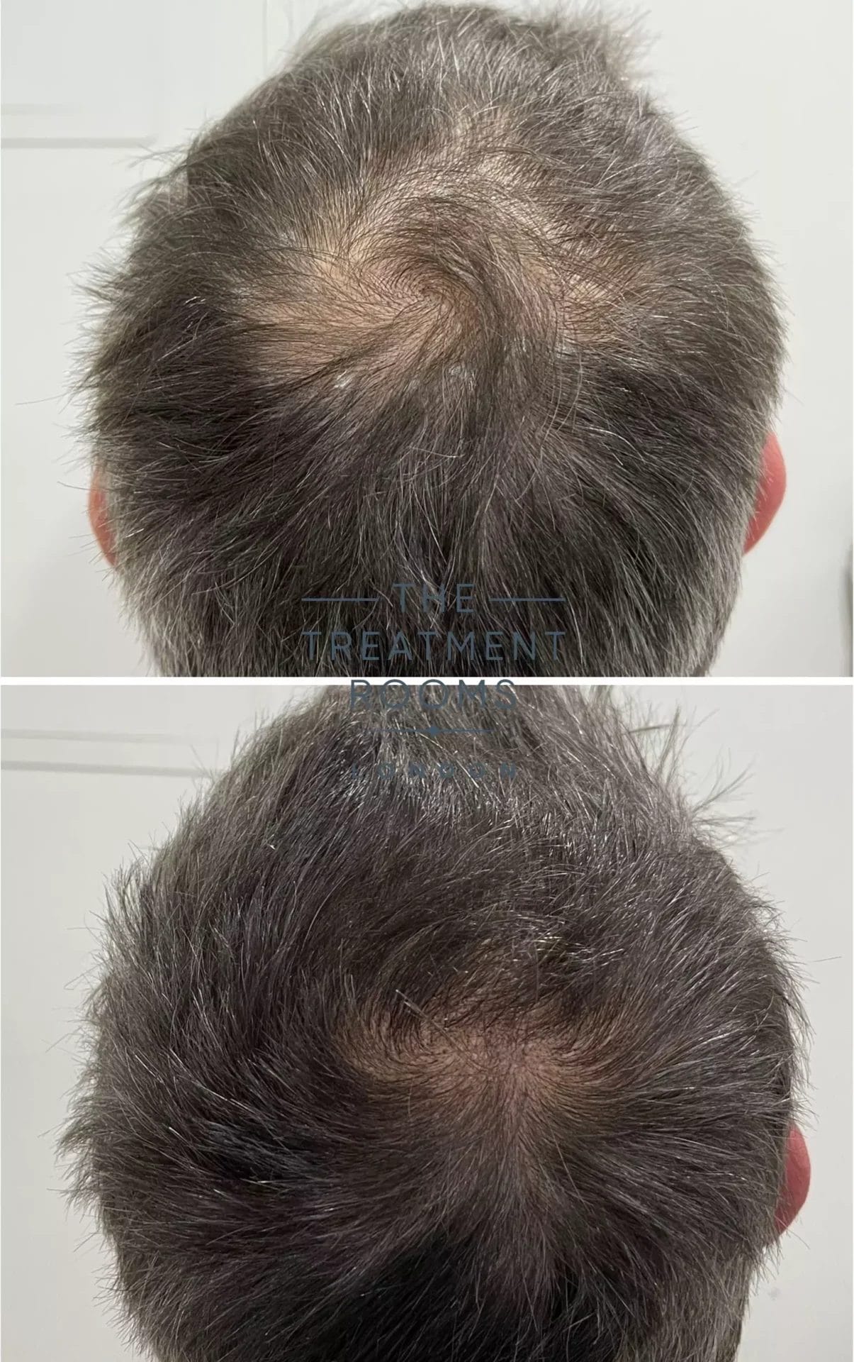 crown hair transplant clinic before and after 597 grafts