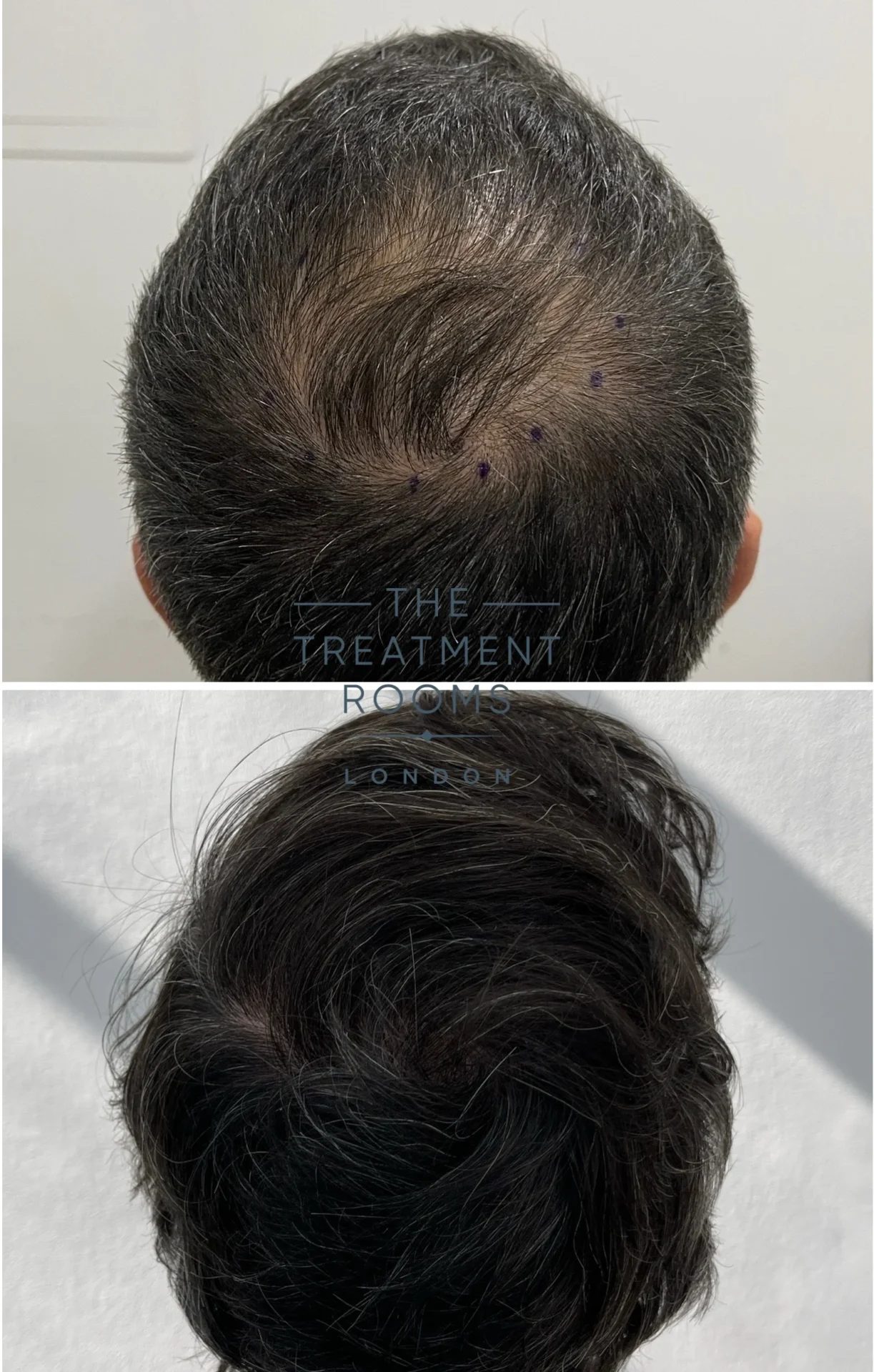 crown hair transplant cost