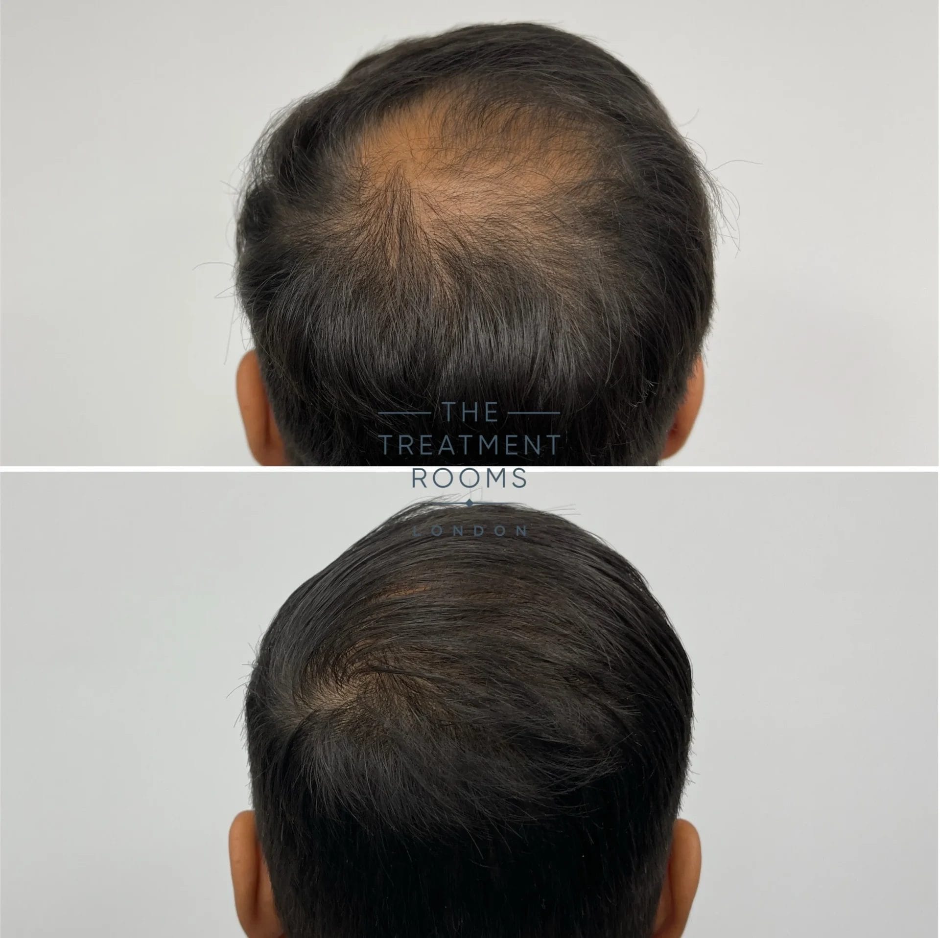 crown hair transplant london 1411 grafts before and after