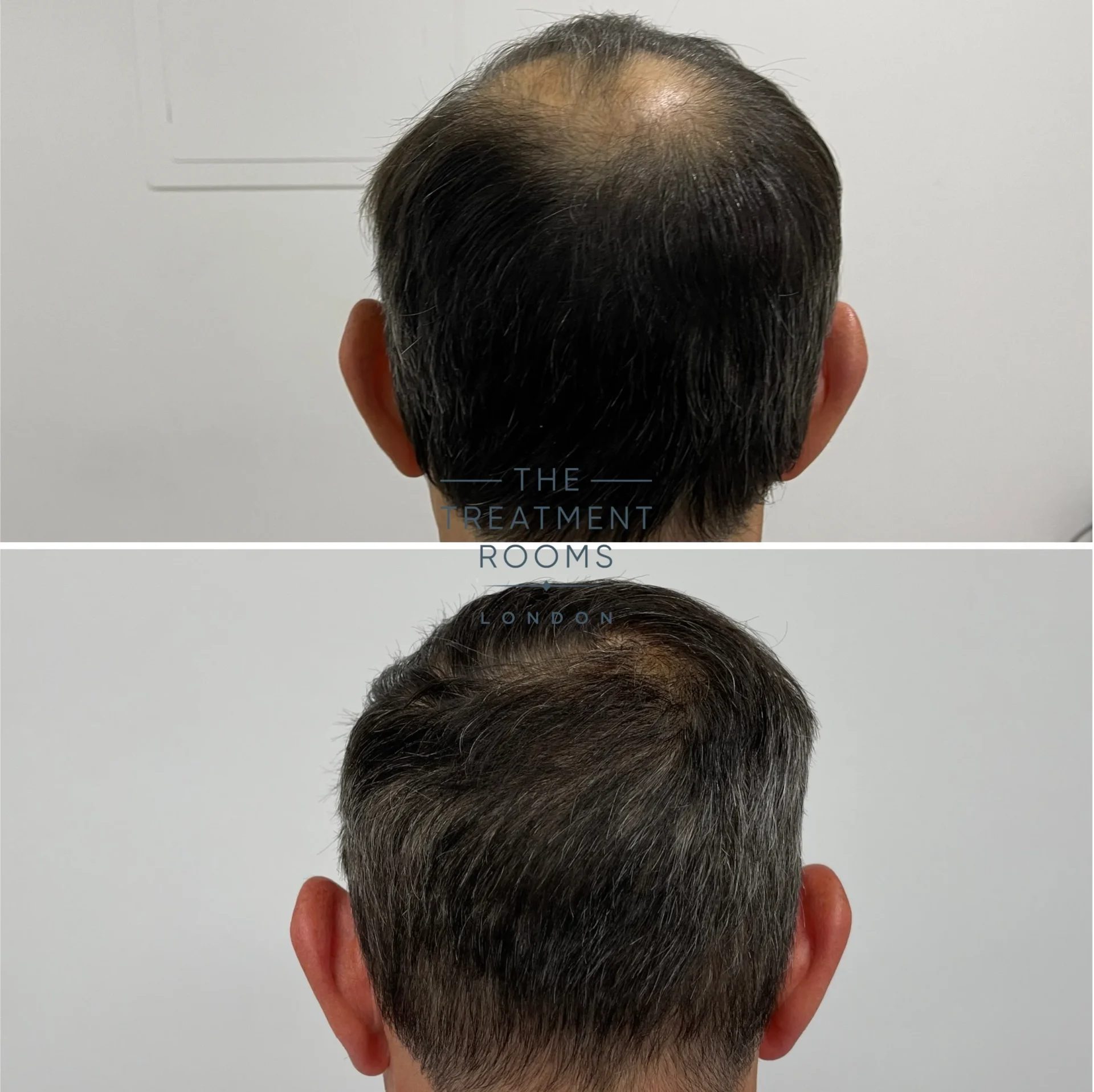 best crown hair transplant review london 1877 grafts before and after