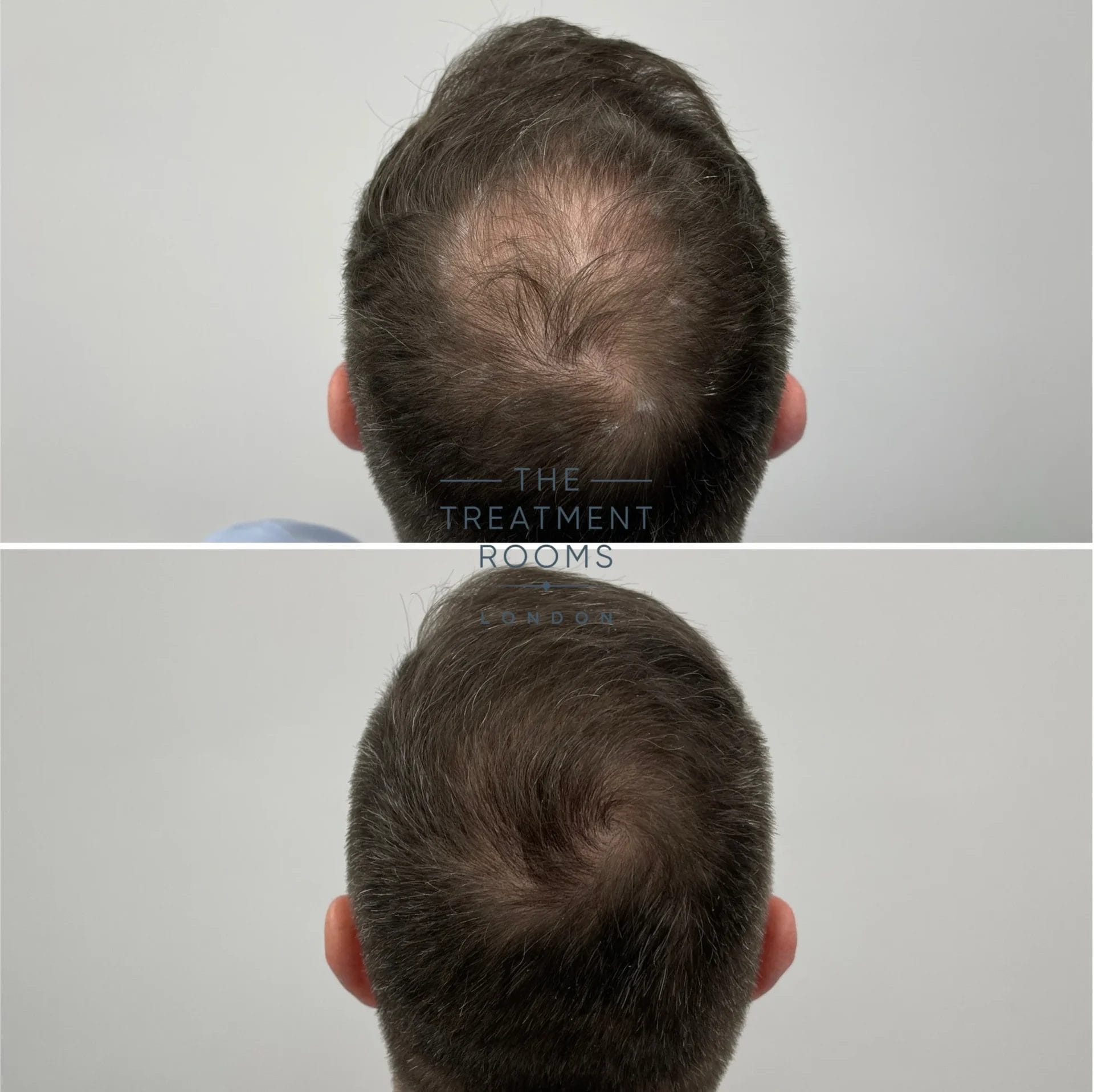 crown hair transplant london 2659 grafts before and after
