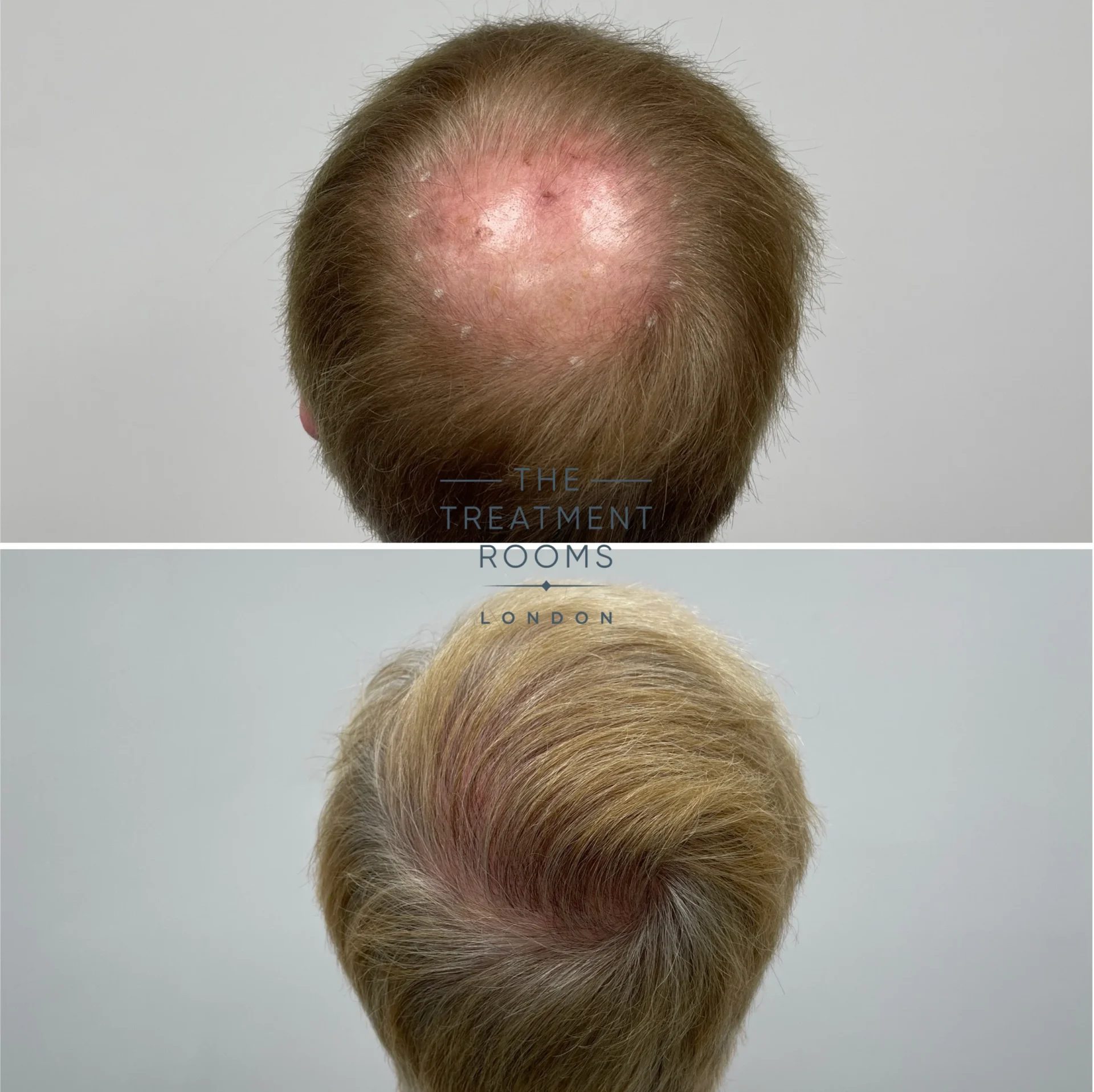 crown hair transplant london result 2078 grafts