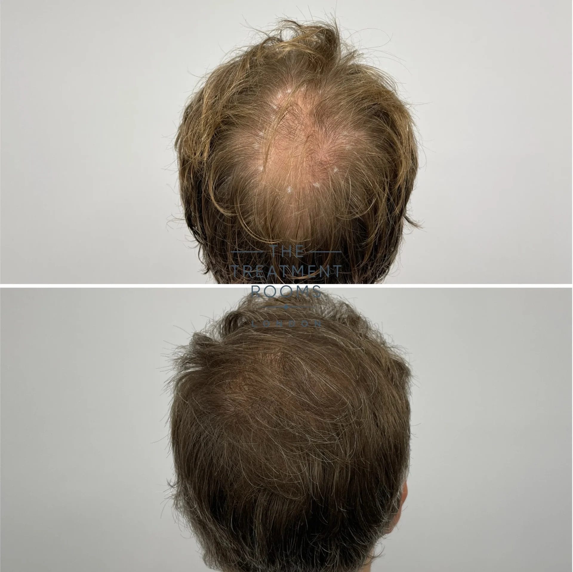 crown transplant 2278 grafts before and after