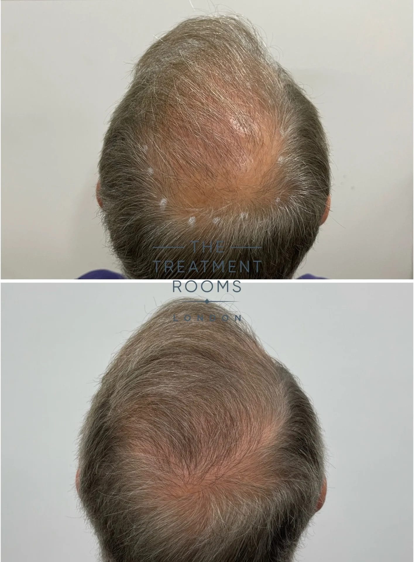 crown transplant before and after 2024 grafts