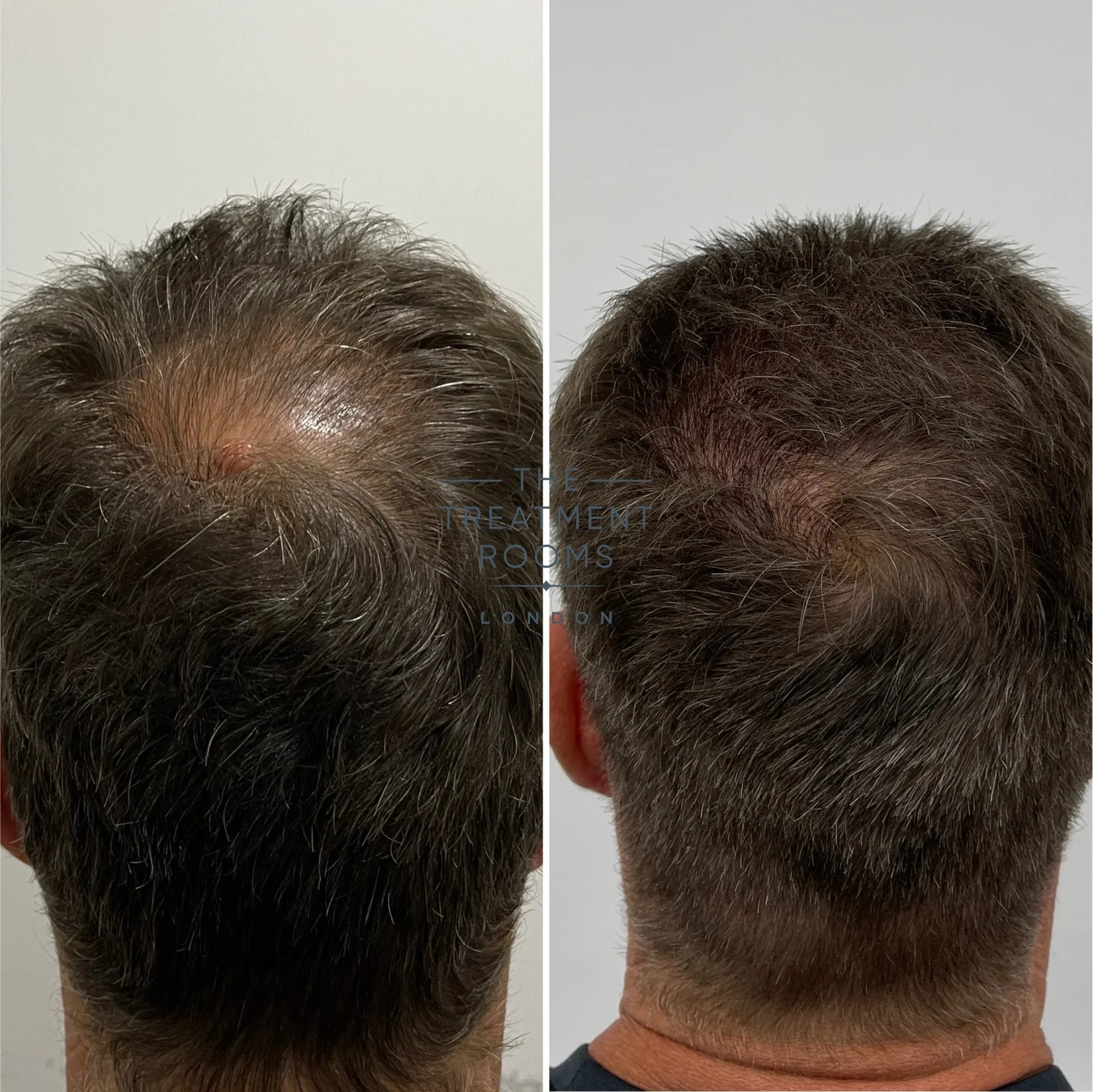 crown transplant london 2227 grafts before and after