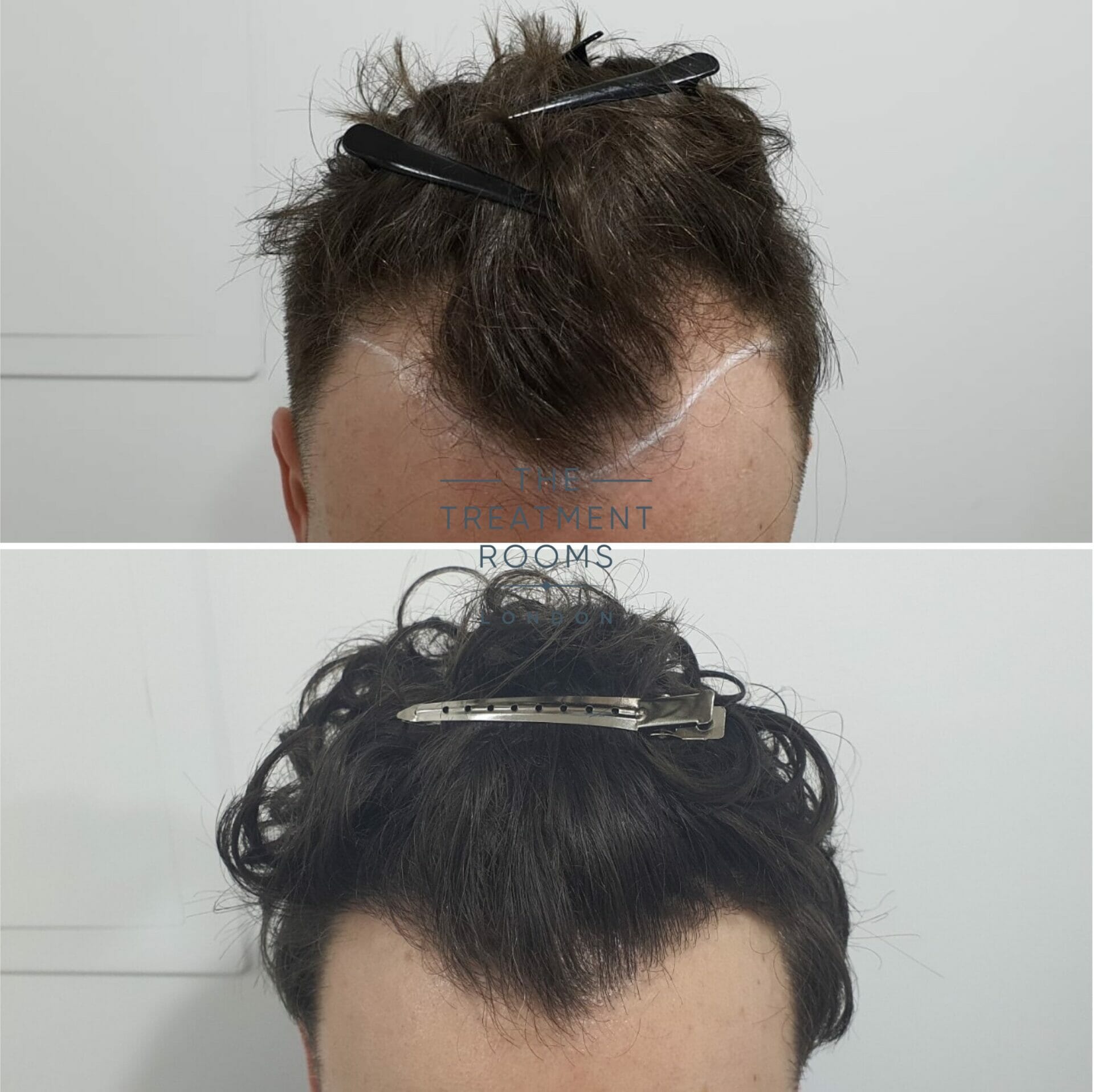 curly hair fue hair transplant before and after curly hair fue hair transplant before and after