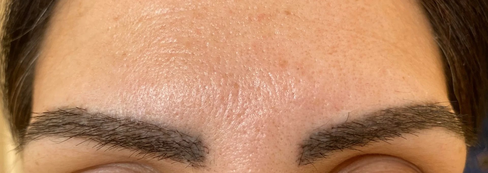 day 14 after eyebrow hair transplant