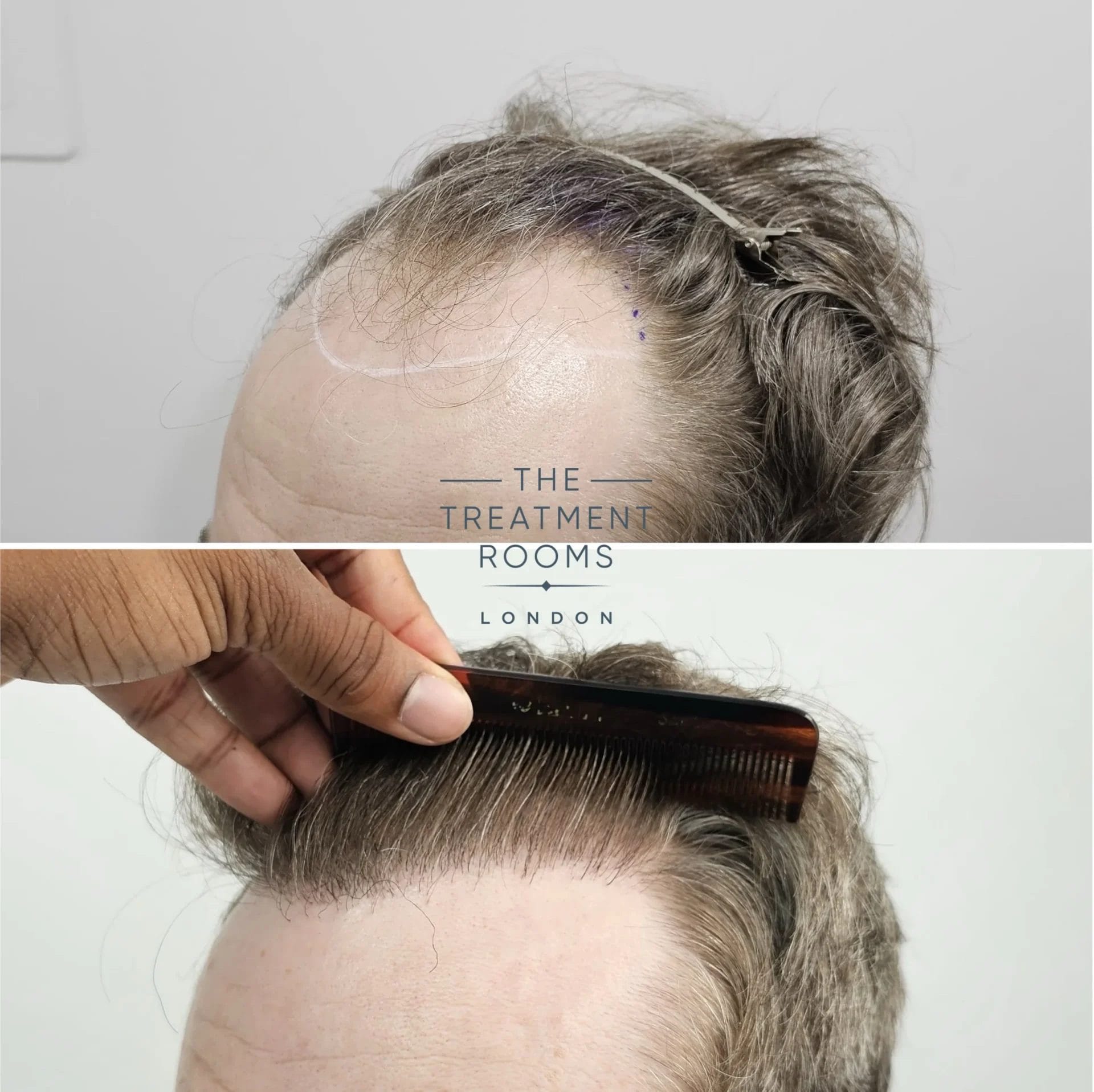 dhi hairline transplant before and after 2069 grafts