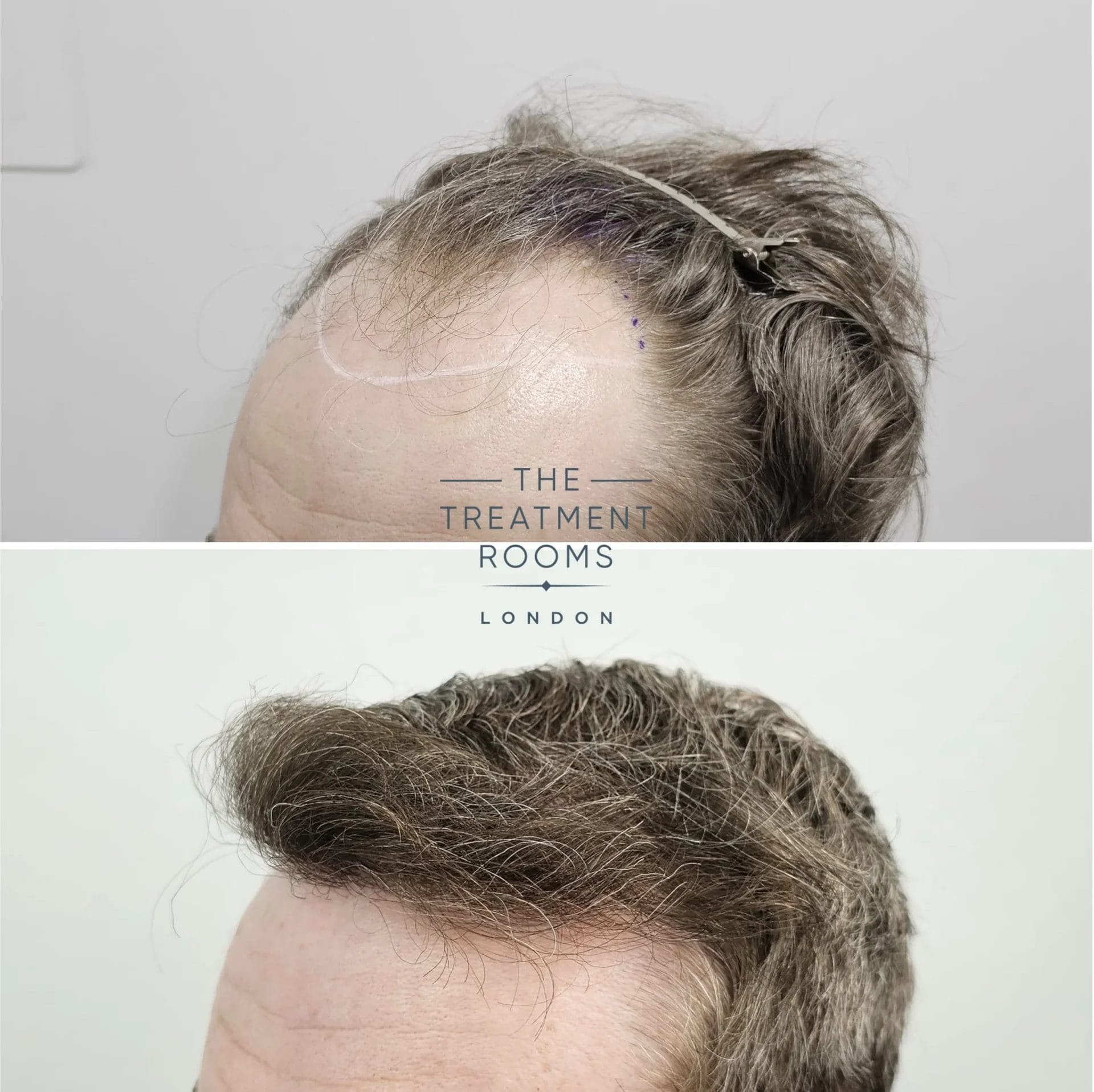 dhi transplant london before and after 2069 grafts