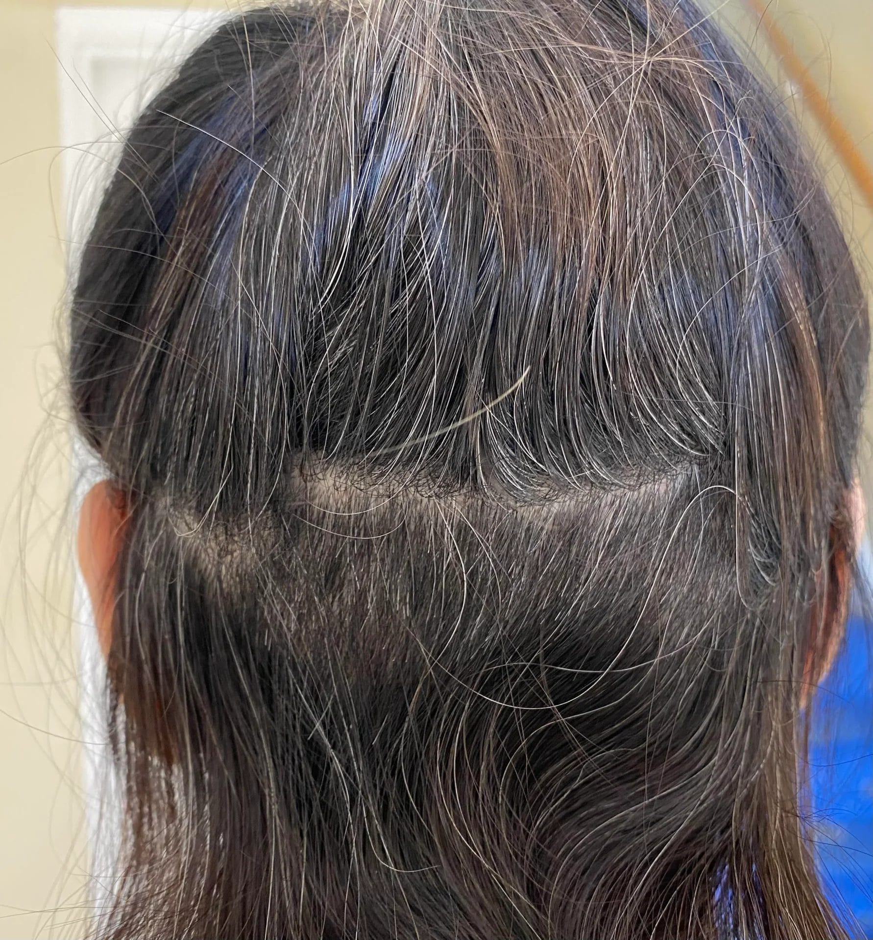 donor area after eyebrow hair transplant