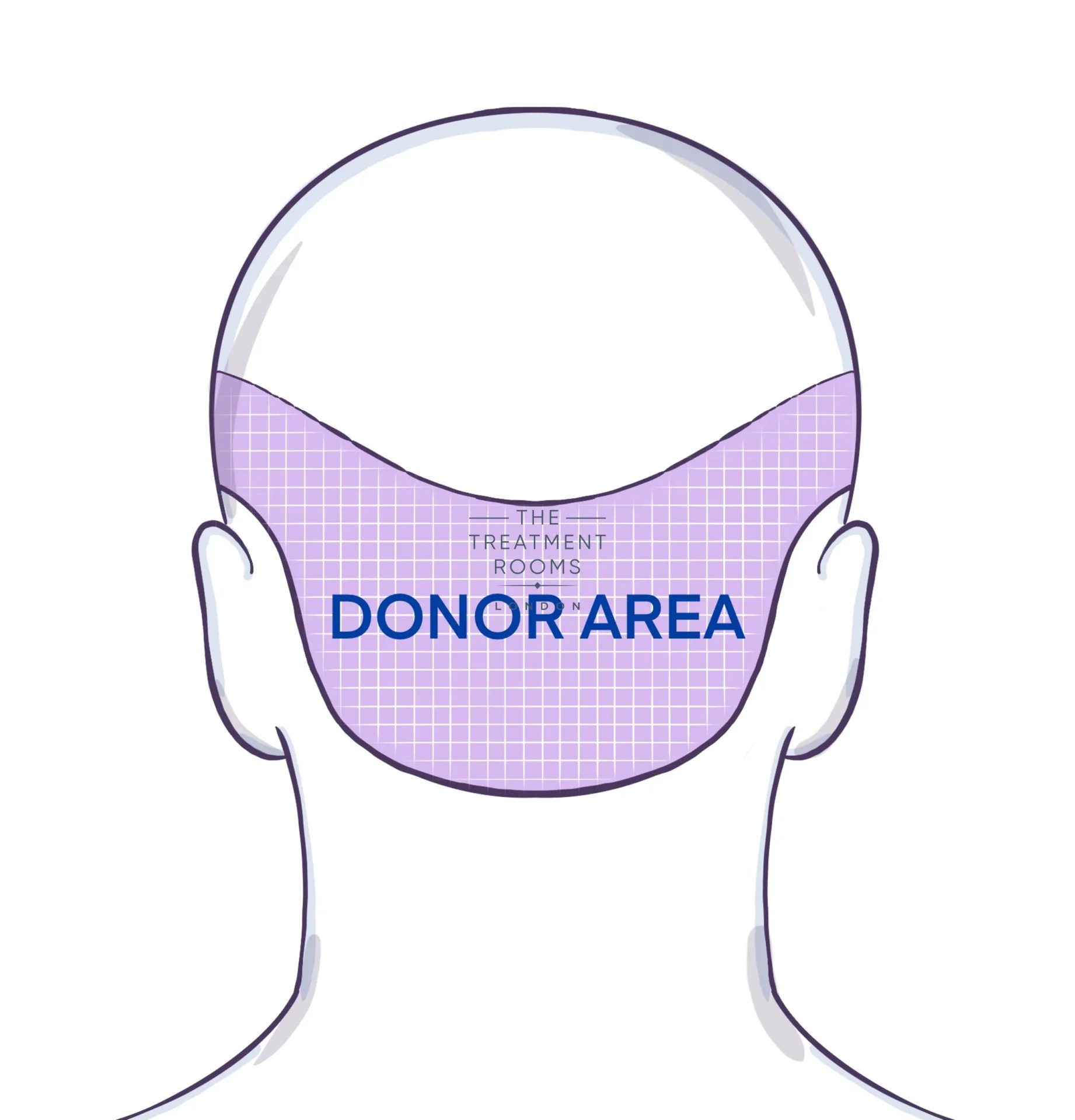 donor area diagram