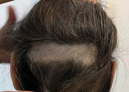 donor area tiered or window shave eyebrow hair transplant