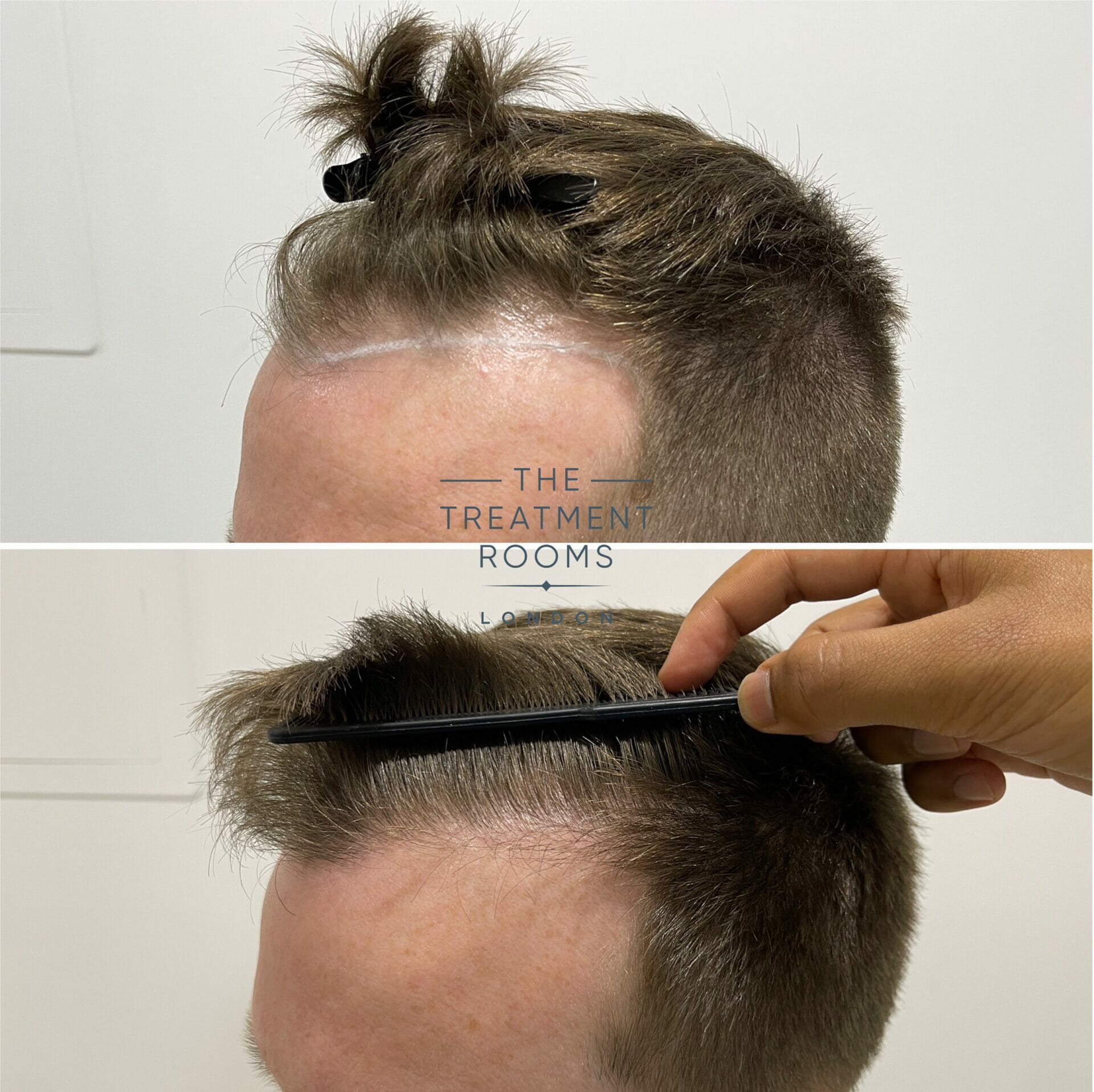 dutasteride after hair transplant