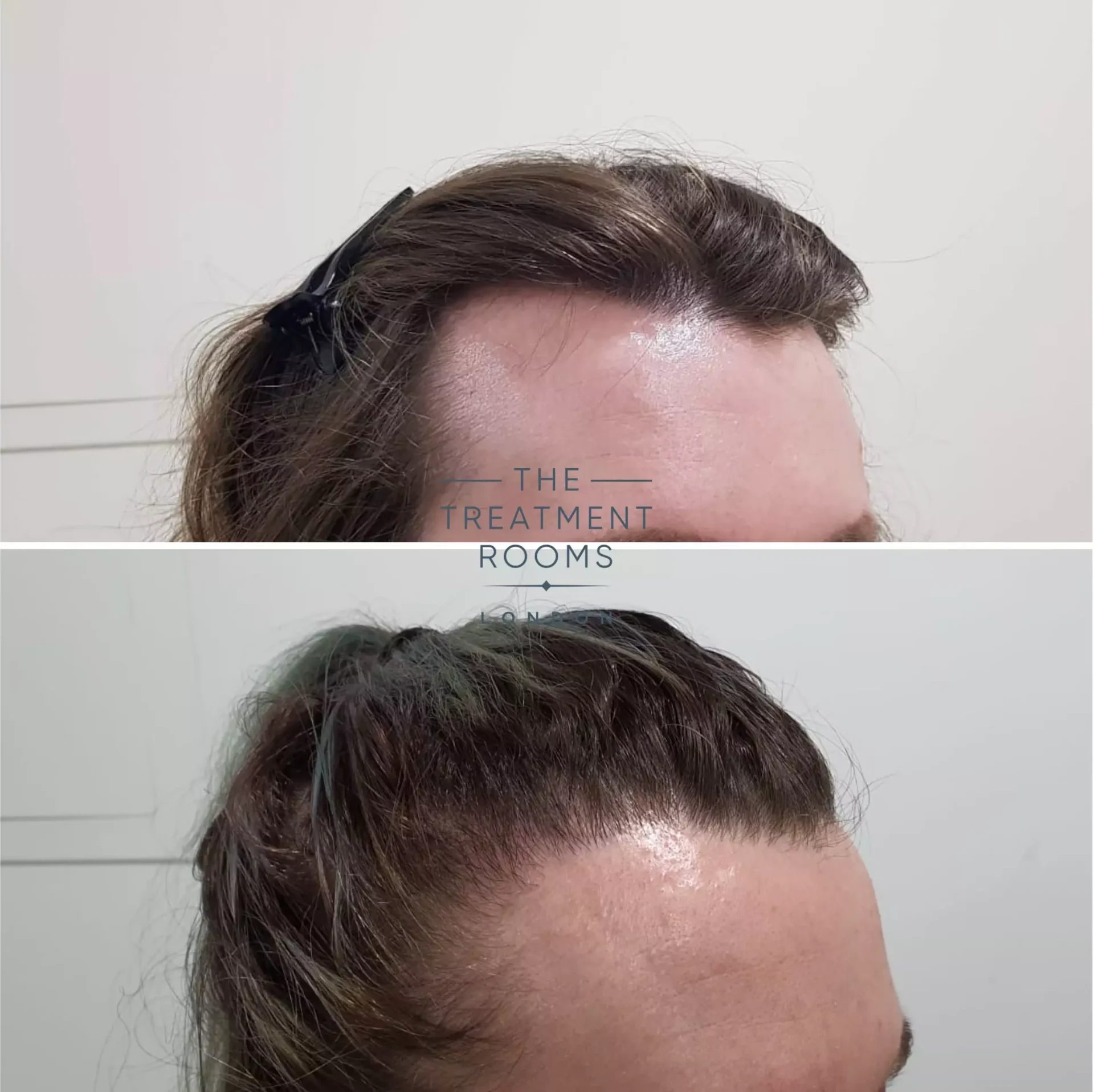 early stage transgender hair transplant mild feminisation 1253 grafts