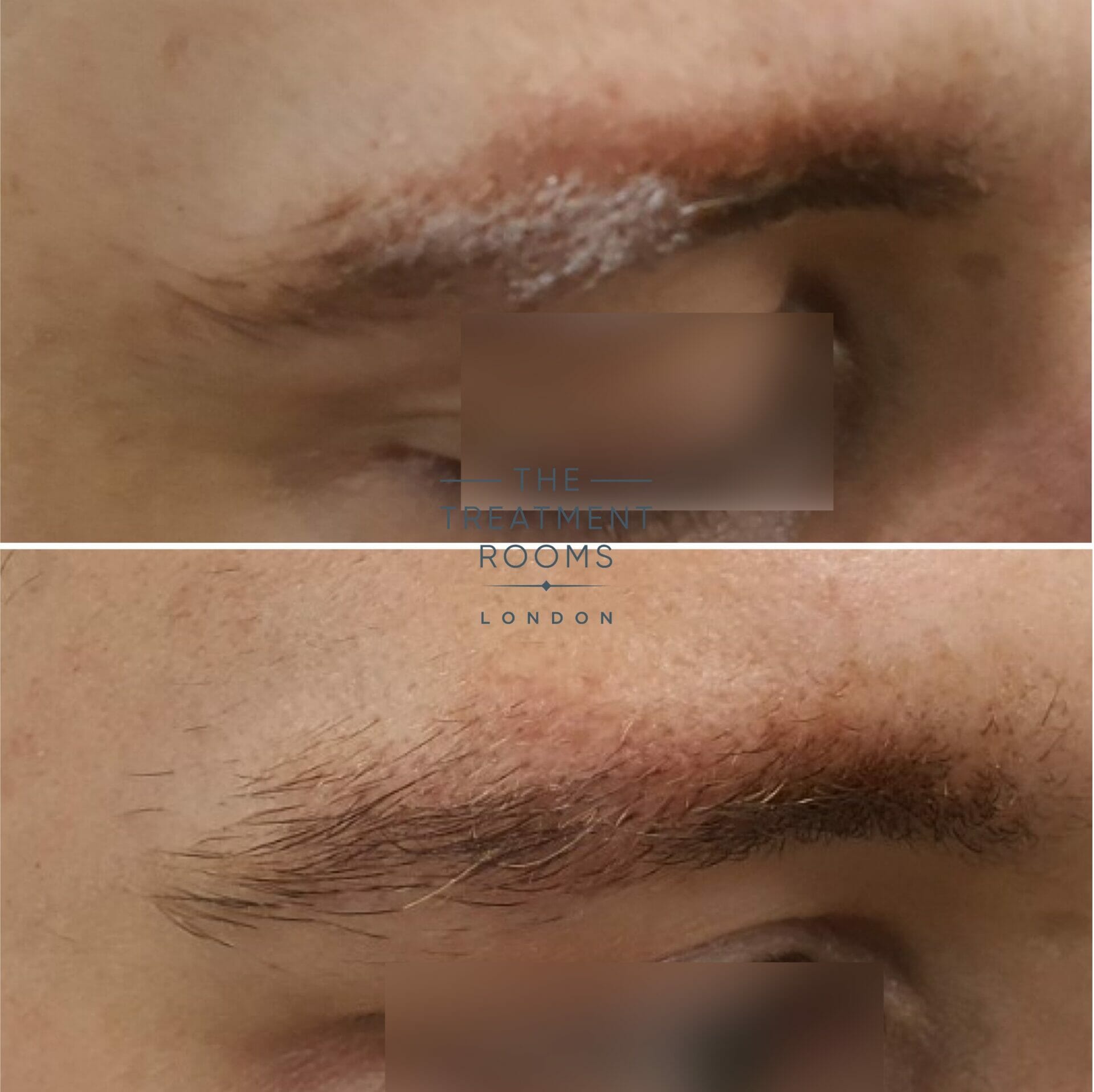 eyebrow hair transplant result