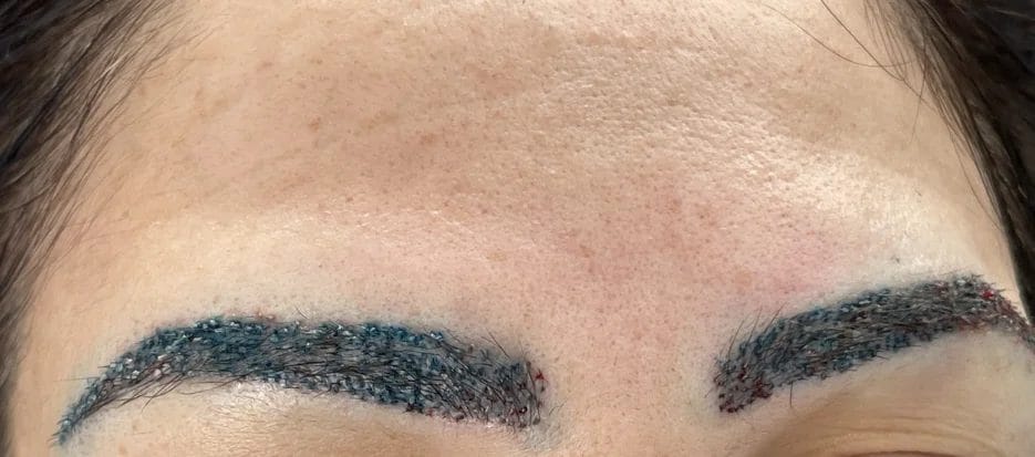 eyebrow hair transplant surgery day