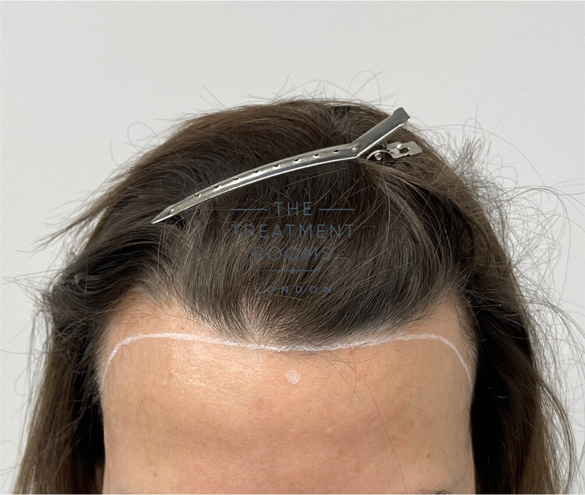 female high hairline example