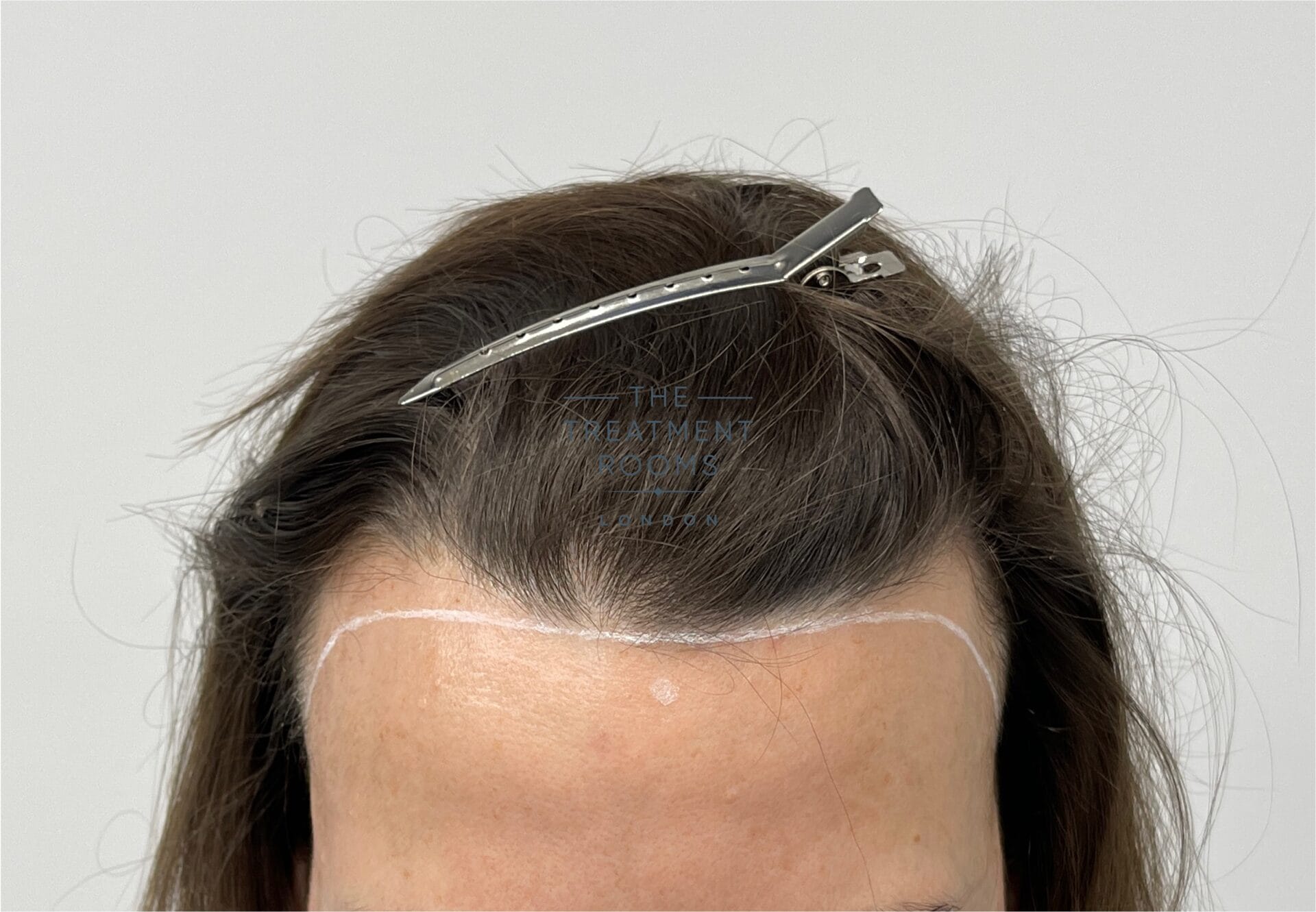 female widows peak hair transplant