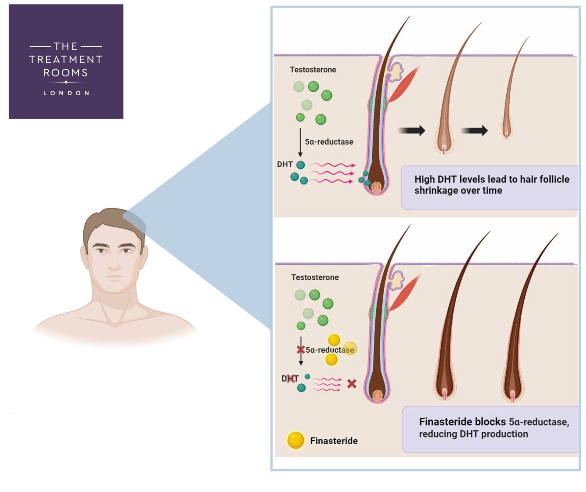 finasteride mechanism diagram