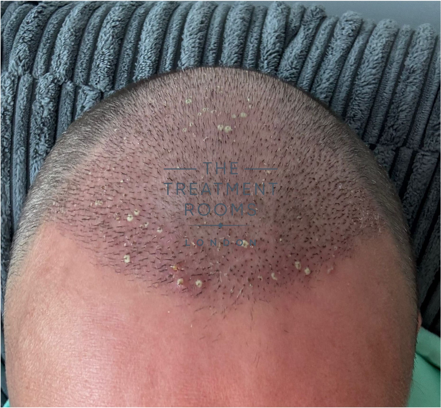 folliculitis example