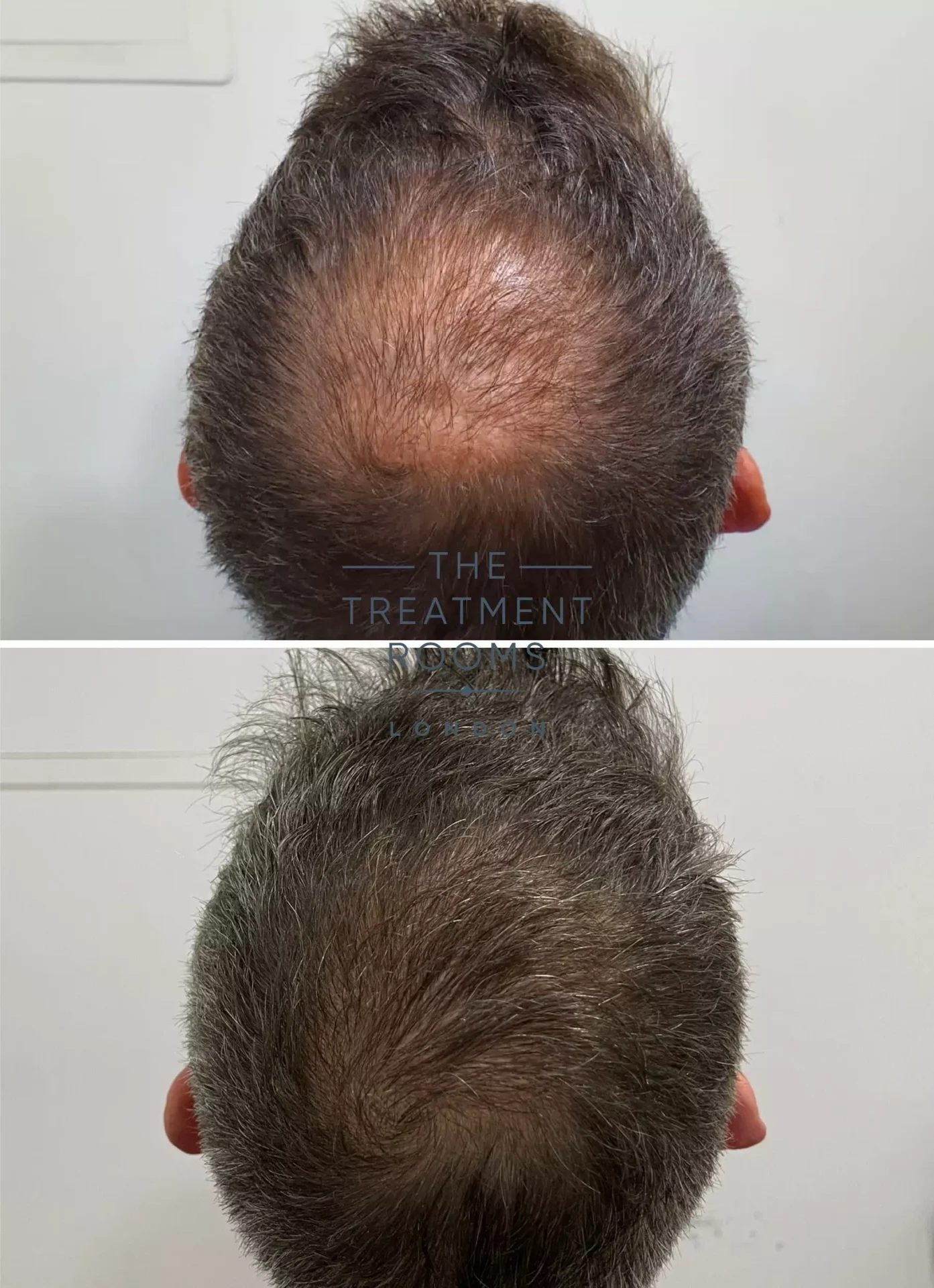 fue clinic crown hair transplant