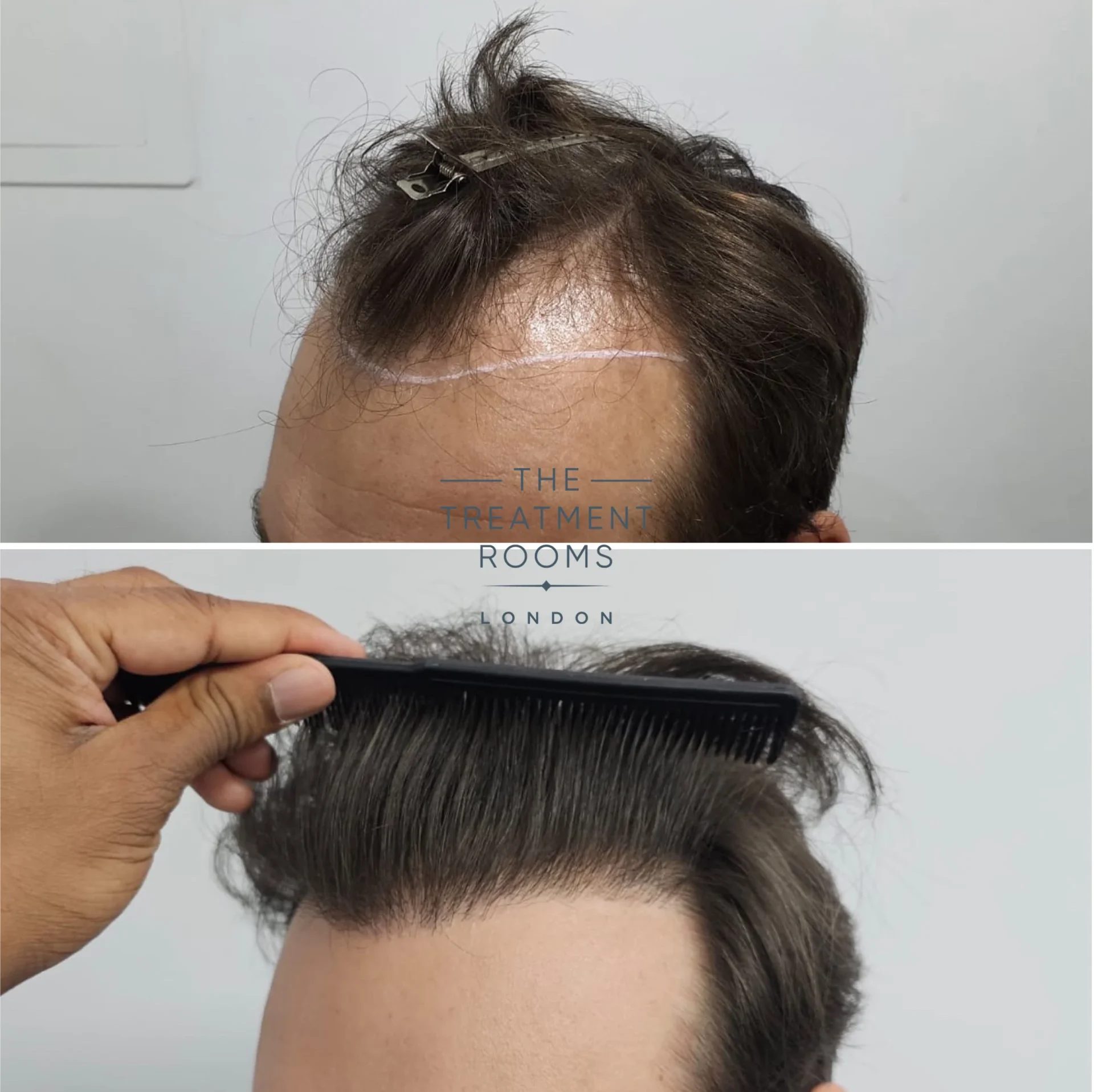 fue hair transplant 1385 grafts before and after hairline fue hair transplant 1385 grafts before and after hairline