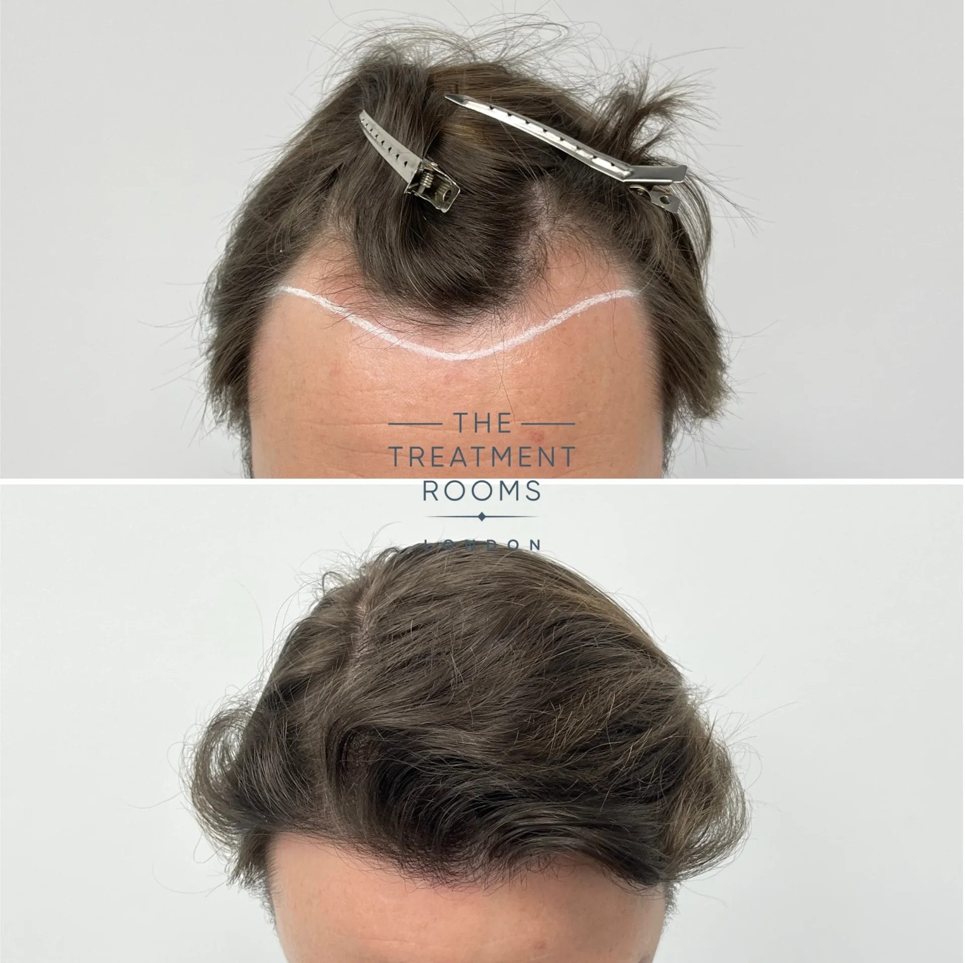 fue hair transplant 1398 grafts before and after
