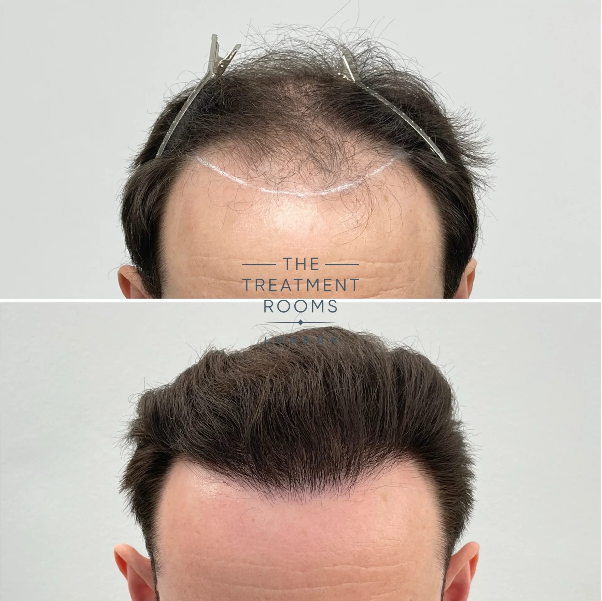 fue hair transplant 1960 grafts before and after