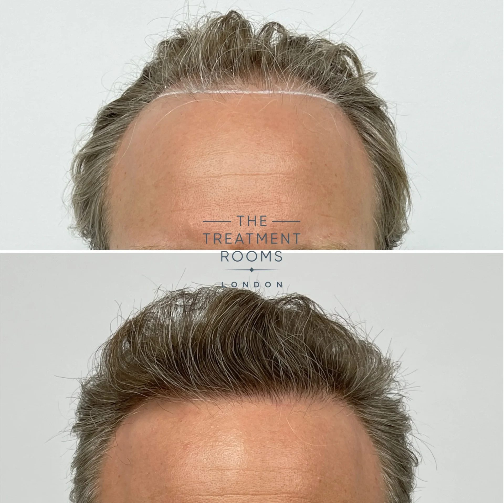 fue hair transplant 2278 grafts before and after