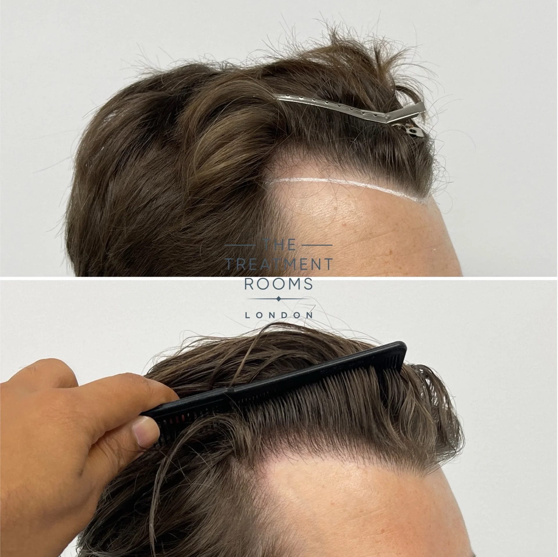 fue hair transplant 976 grafts before and after