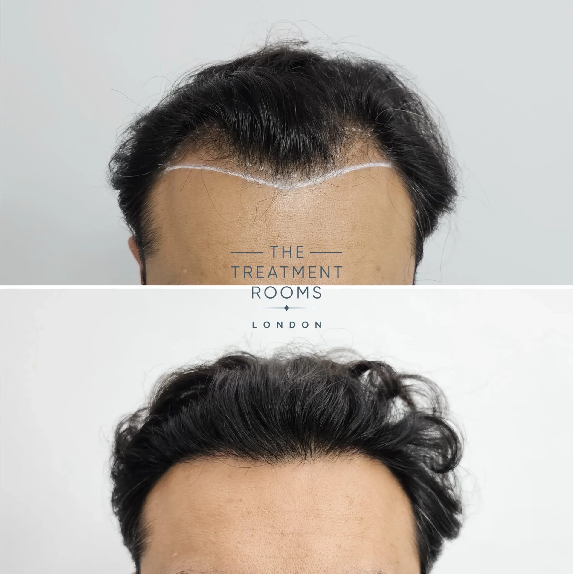 fue hair transplant before and after 1204 grafts