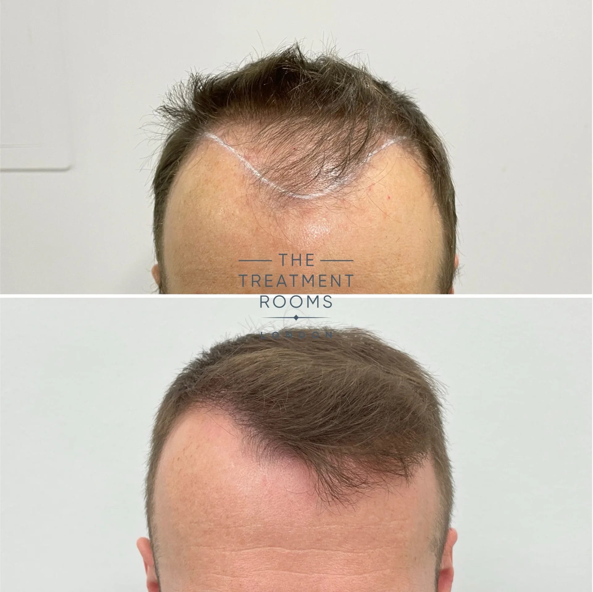 fue hair transplant before and after 1592 grafts