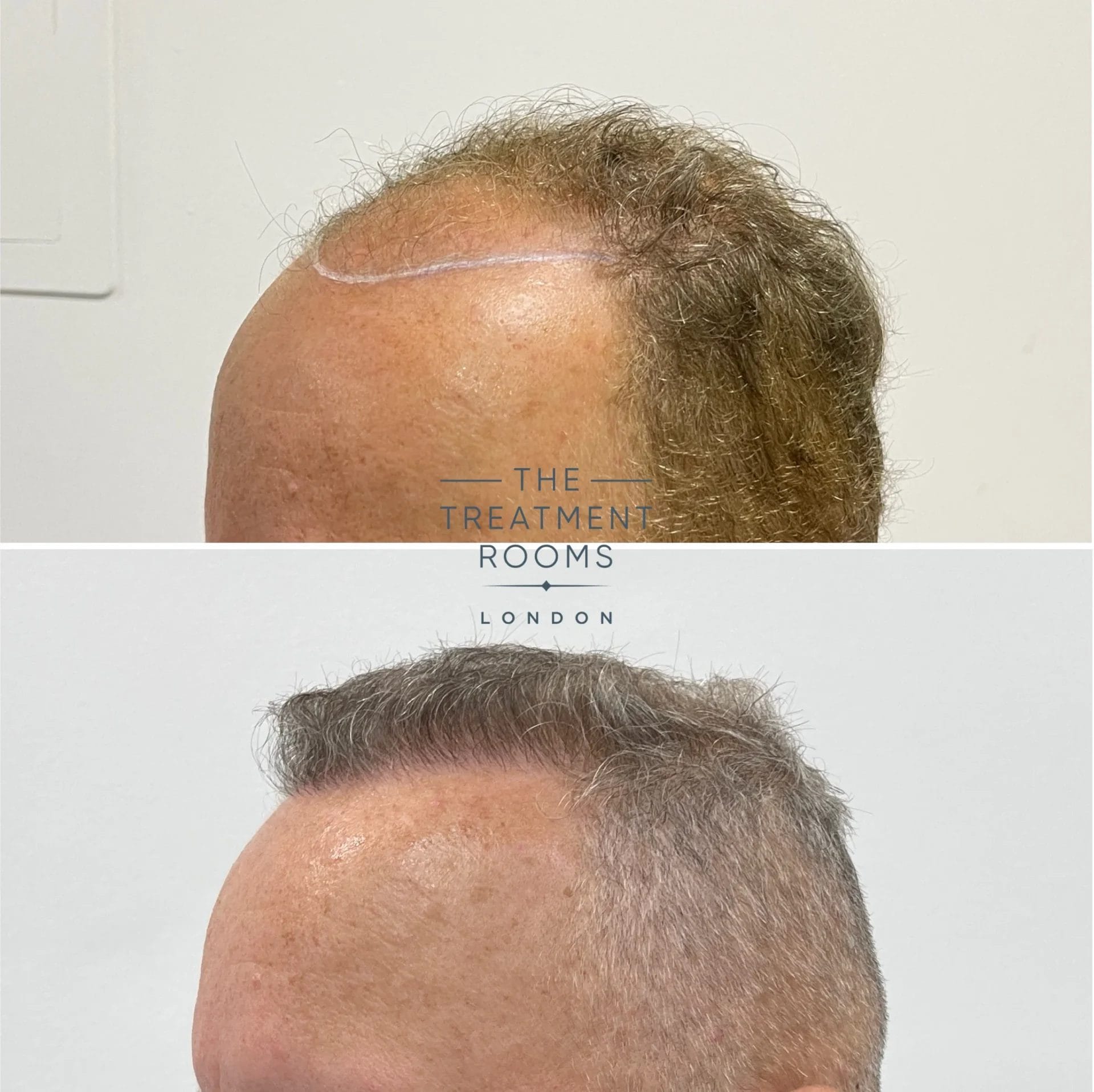 fue hair transplant before and after 1810 grafts
