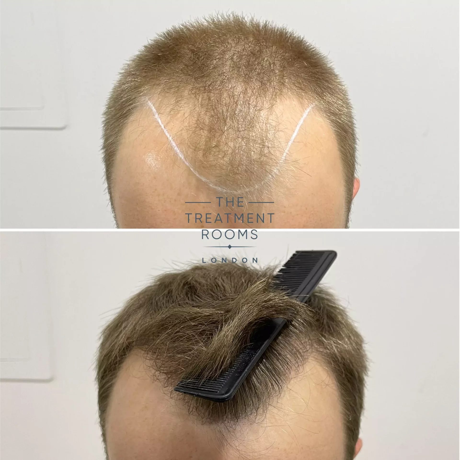 fue hair transplant clinic 1756 grafts before and after fue hair transplant clinic 1756 grafts before and after