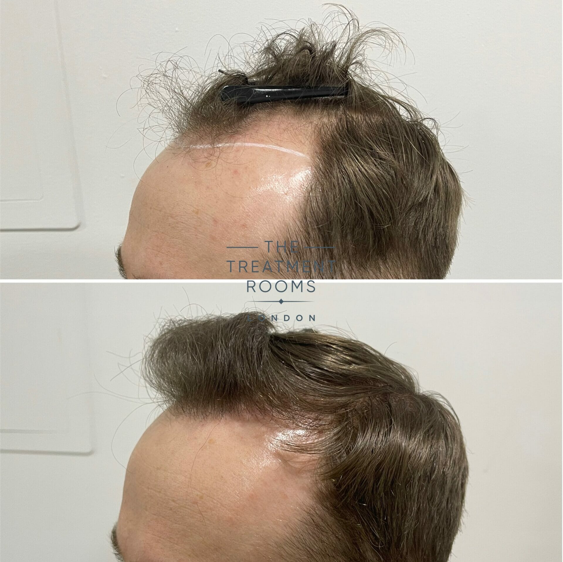 fue hair transplant clinic before and after