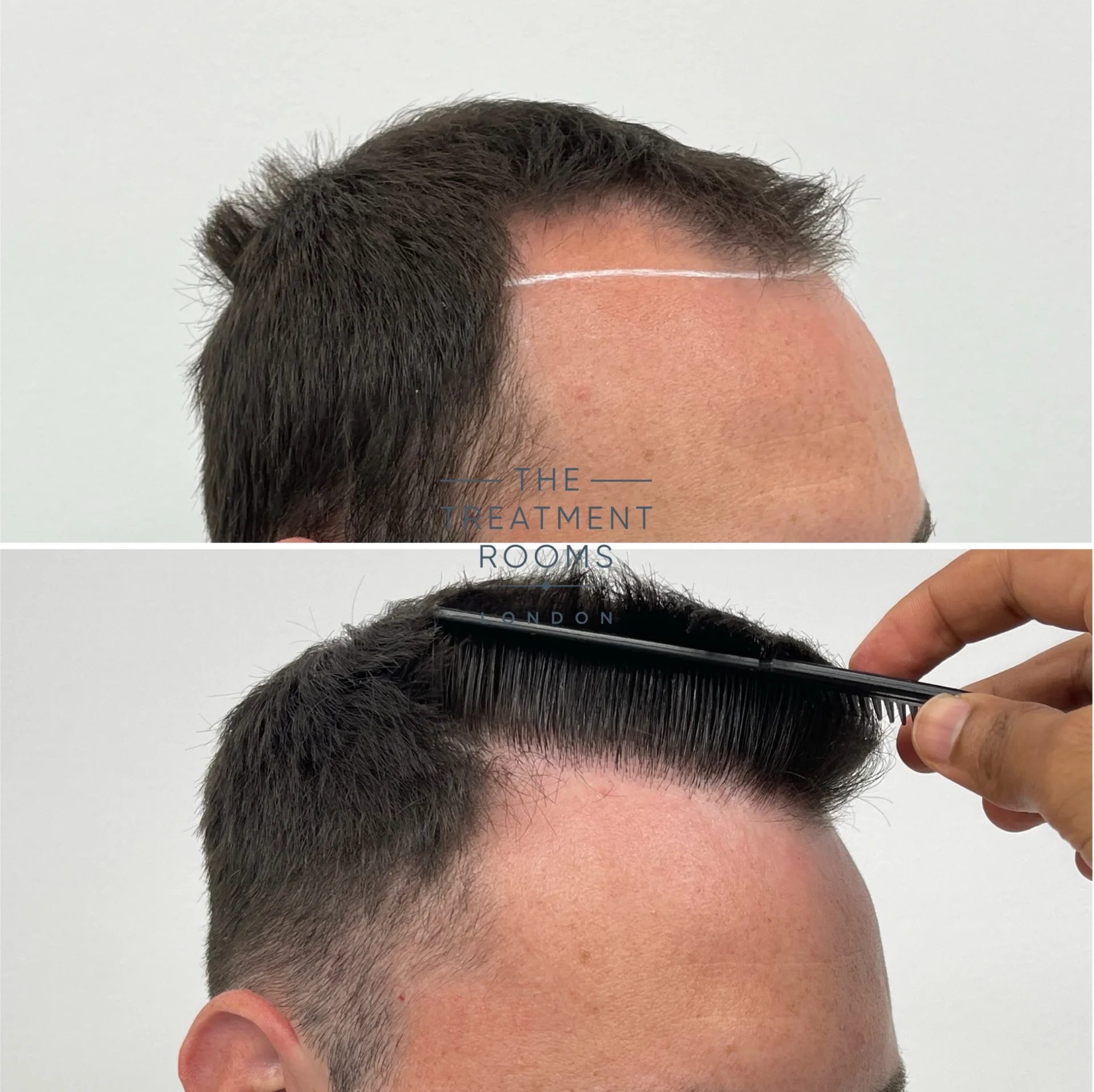 fue hair transplant london 1924 grafts before and after