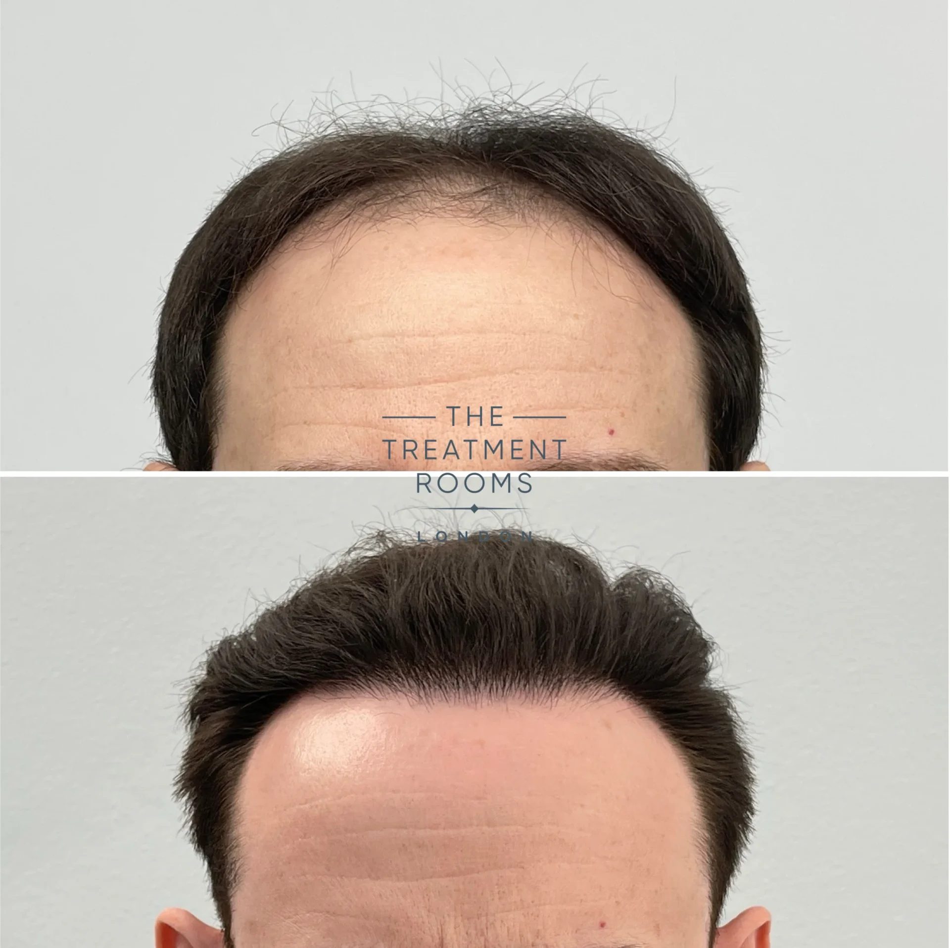 fue hair transplant london 1960 grafts before and after