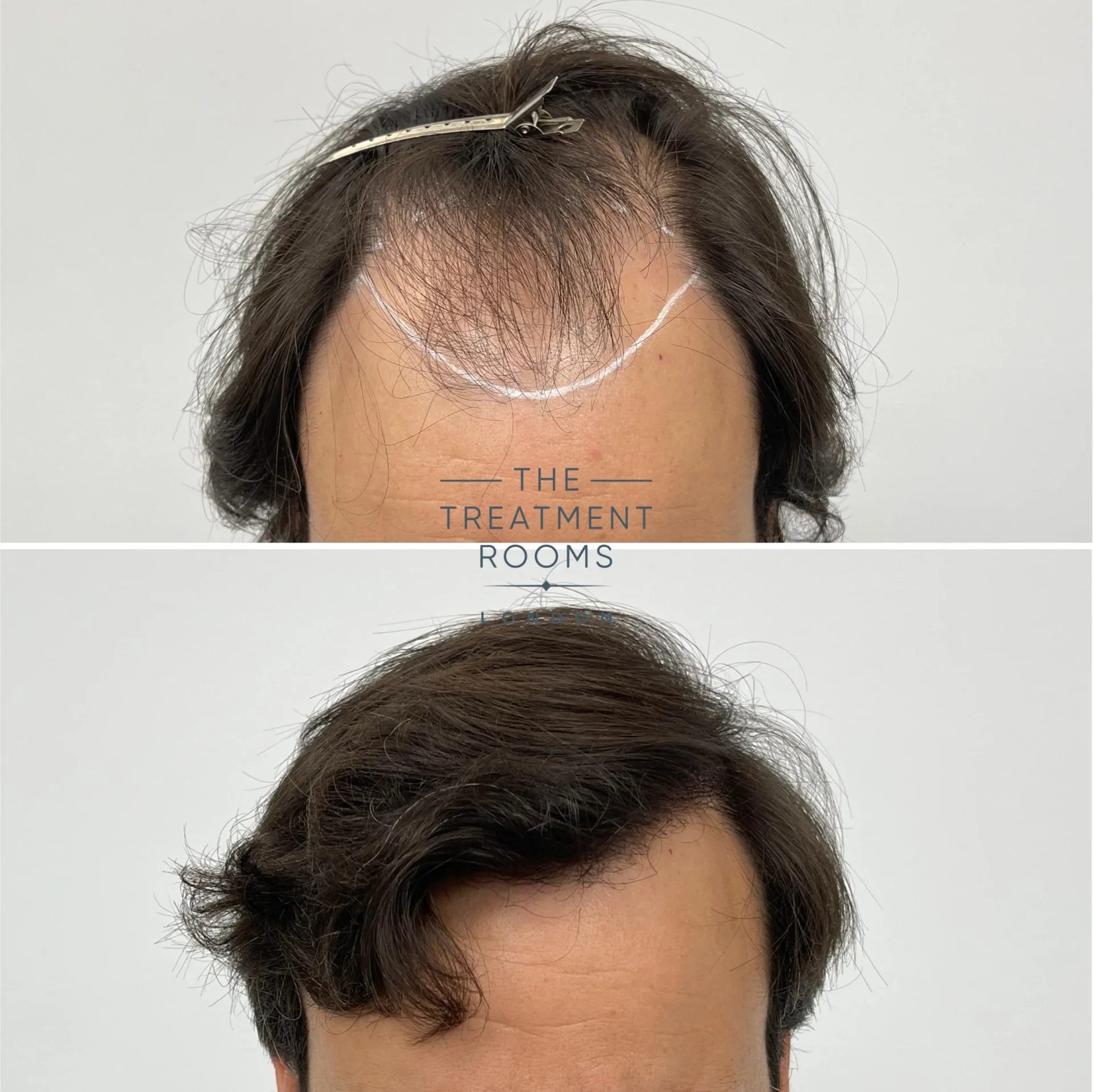 fue hair transplant london 2148 grafts before and after