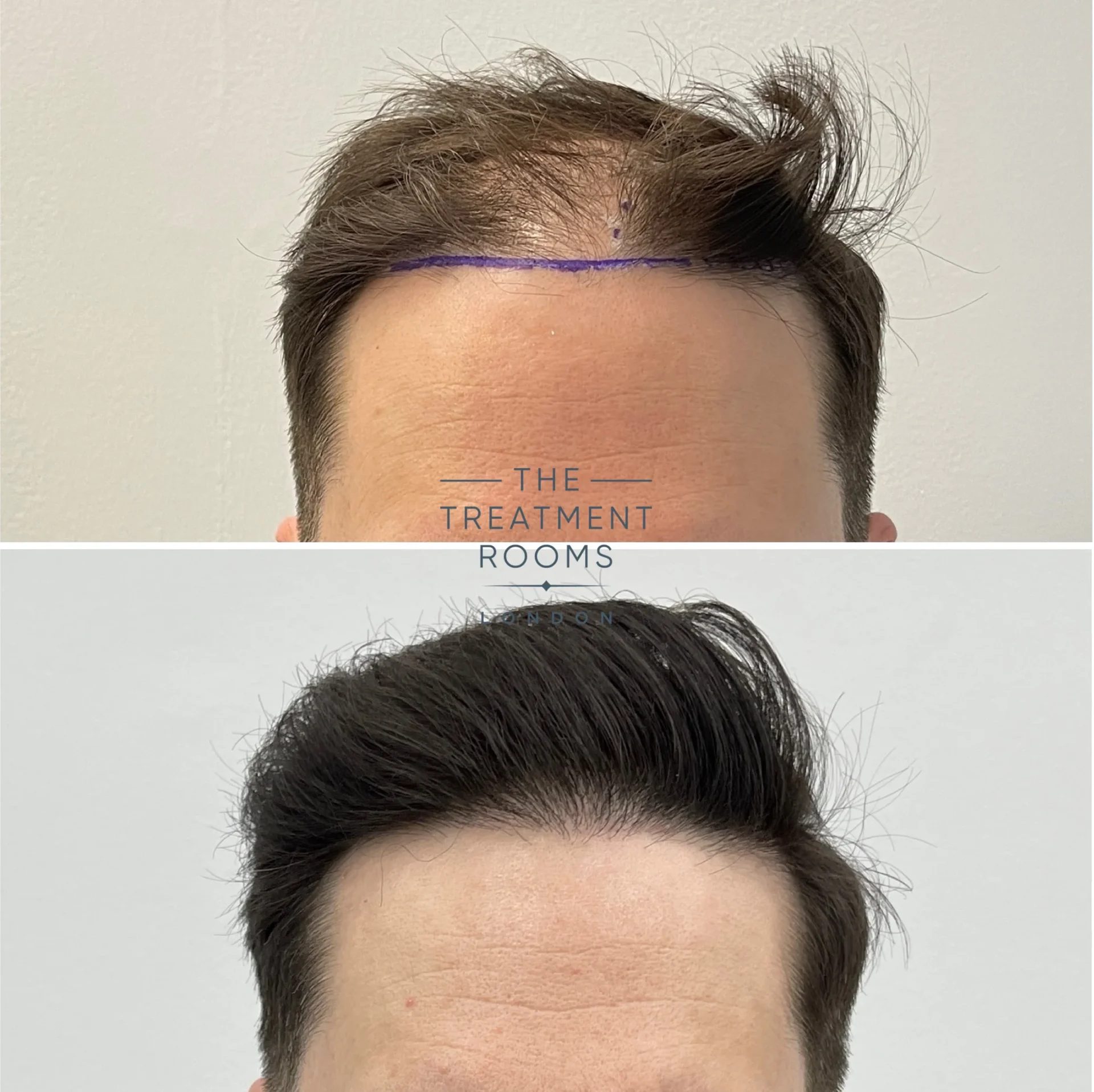 fue hair transplant london before and after 1625 grafts