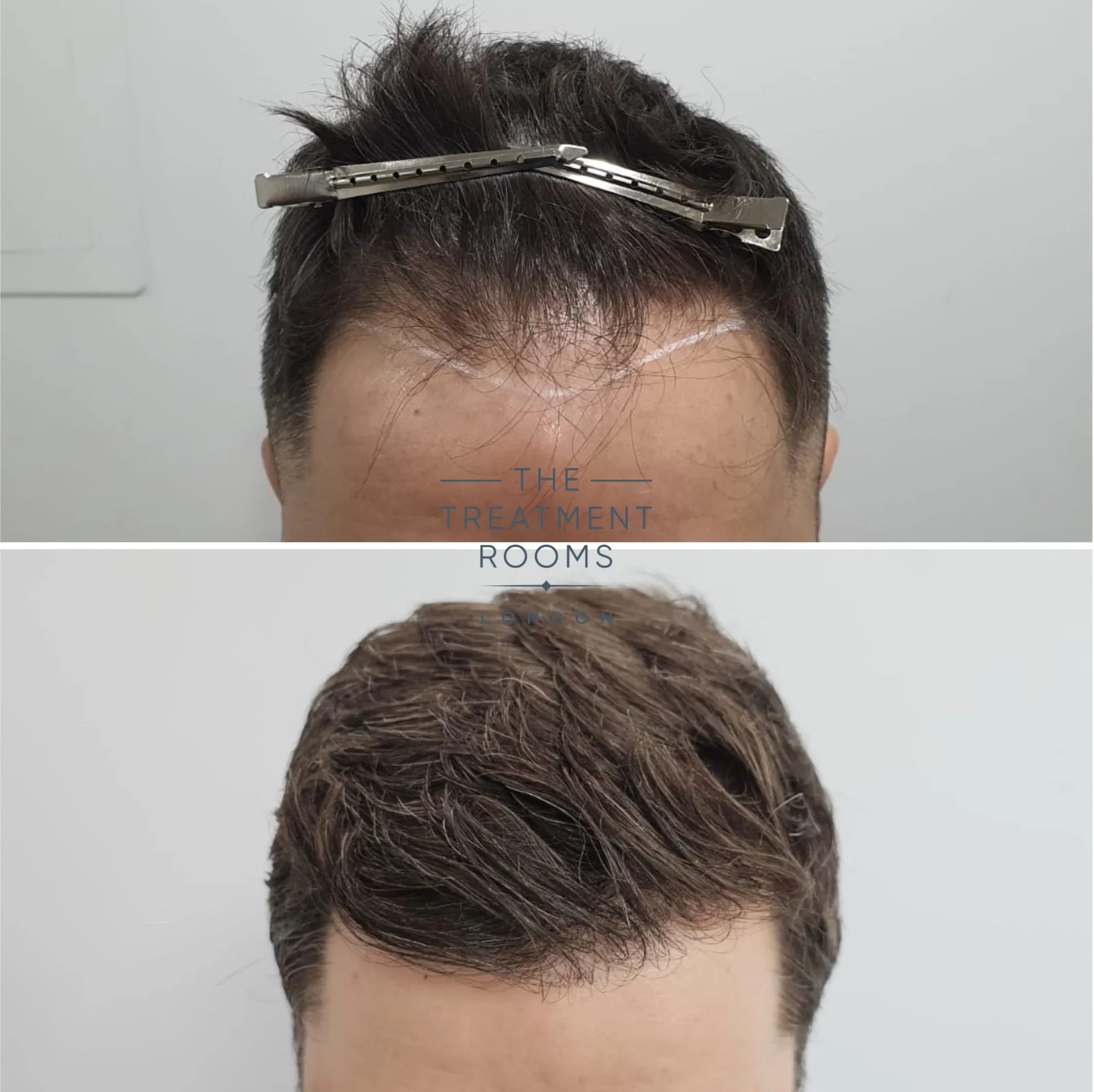 fue hair transplant london hairline 1098 grafts result fue hair transplant london hairline 1098 grafts result