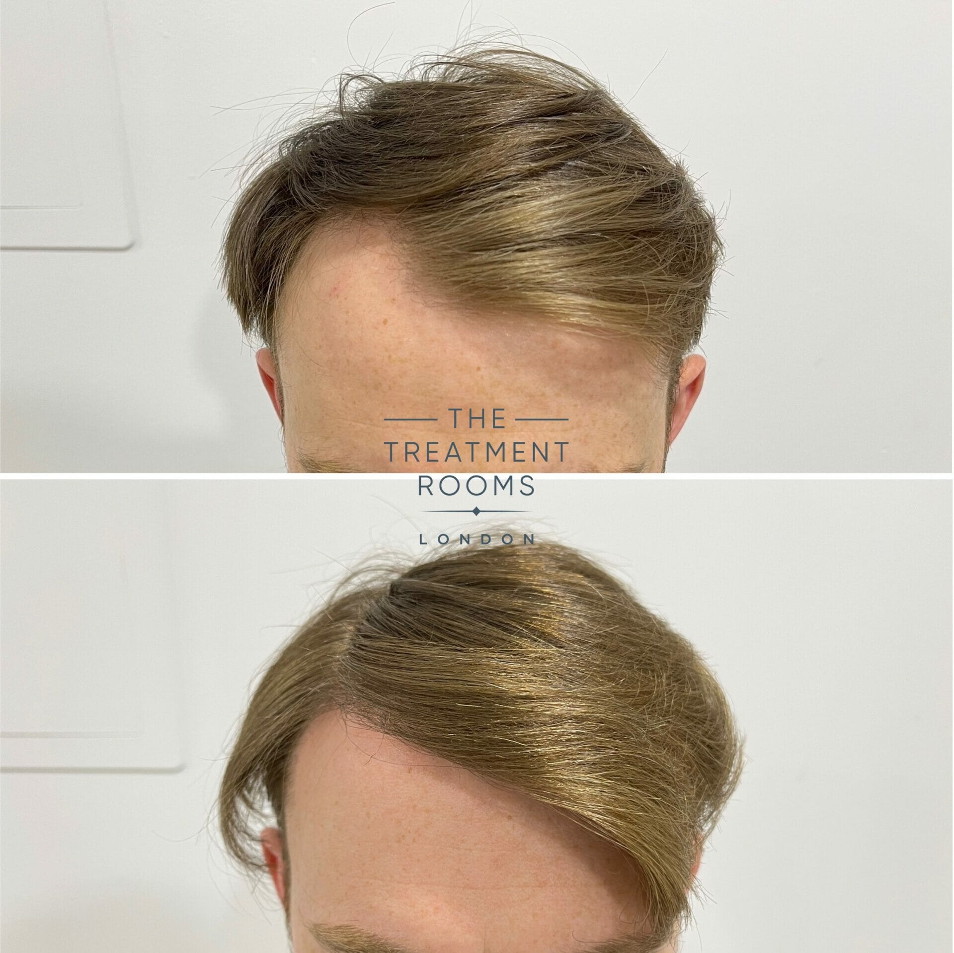 fue hair transplant london result 1700 grafts