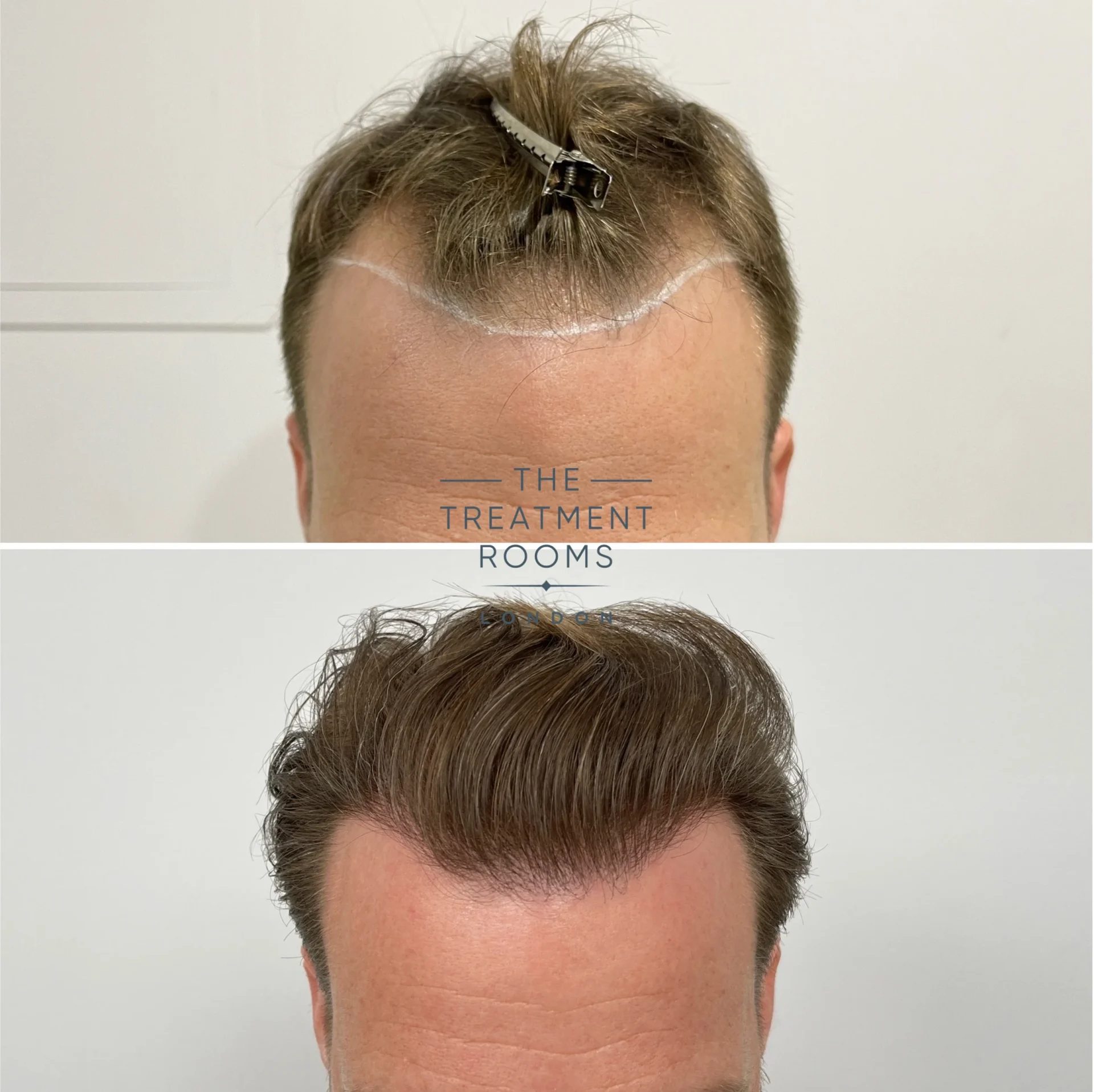 fue hair transplant receding hairline before and after 1566 grafts fue hair transplant receding hairline before and after 1566 grafts