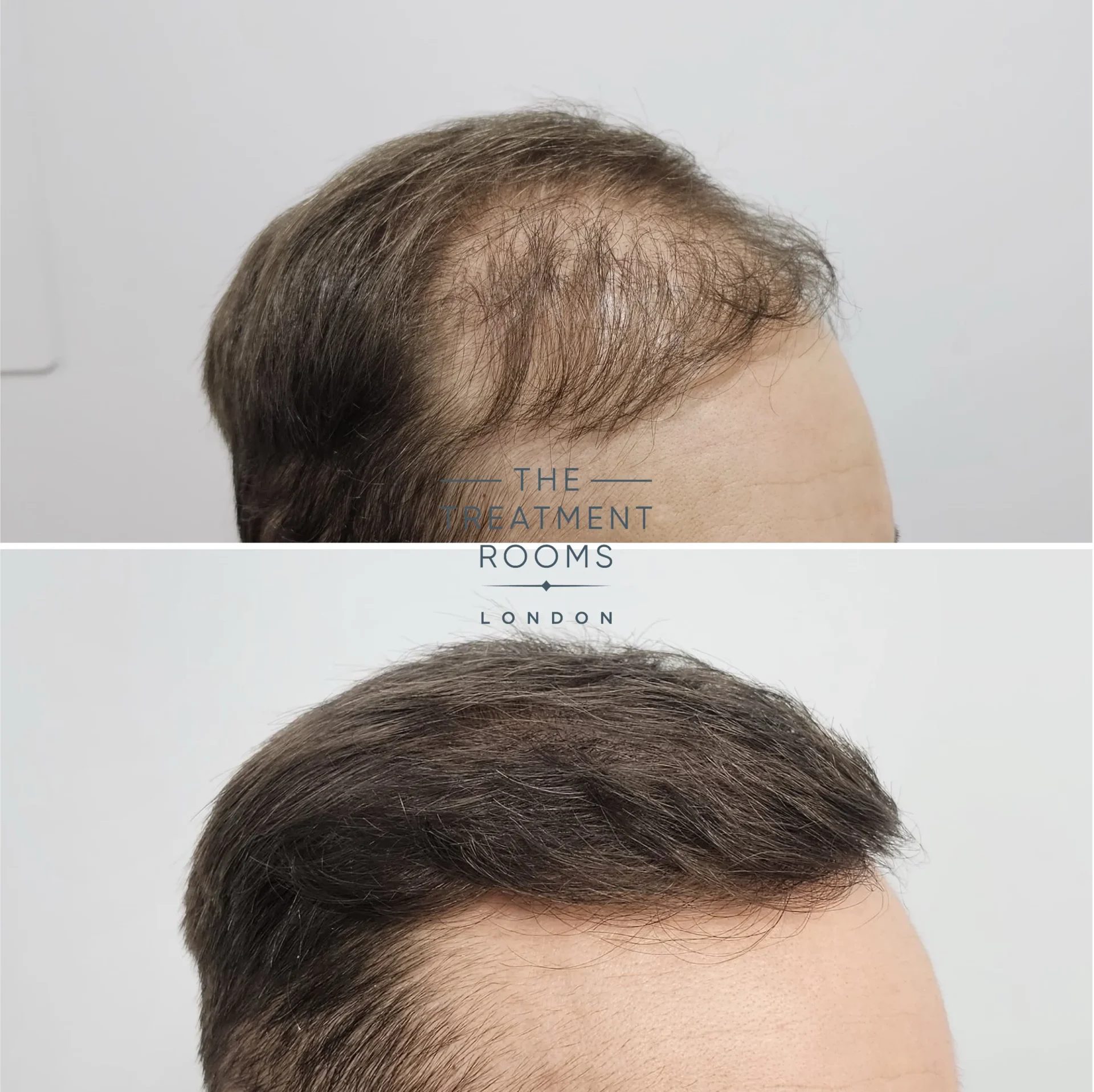 fue hair transplant repair 1733 grafts before and after