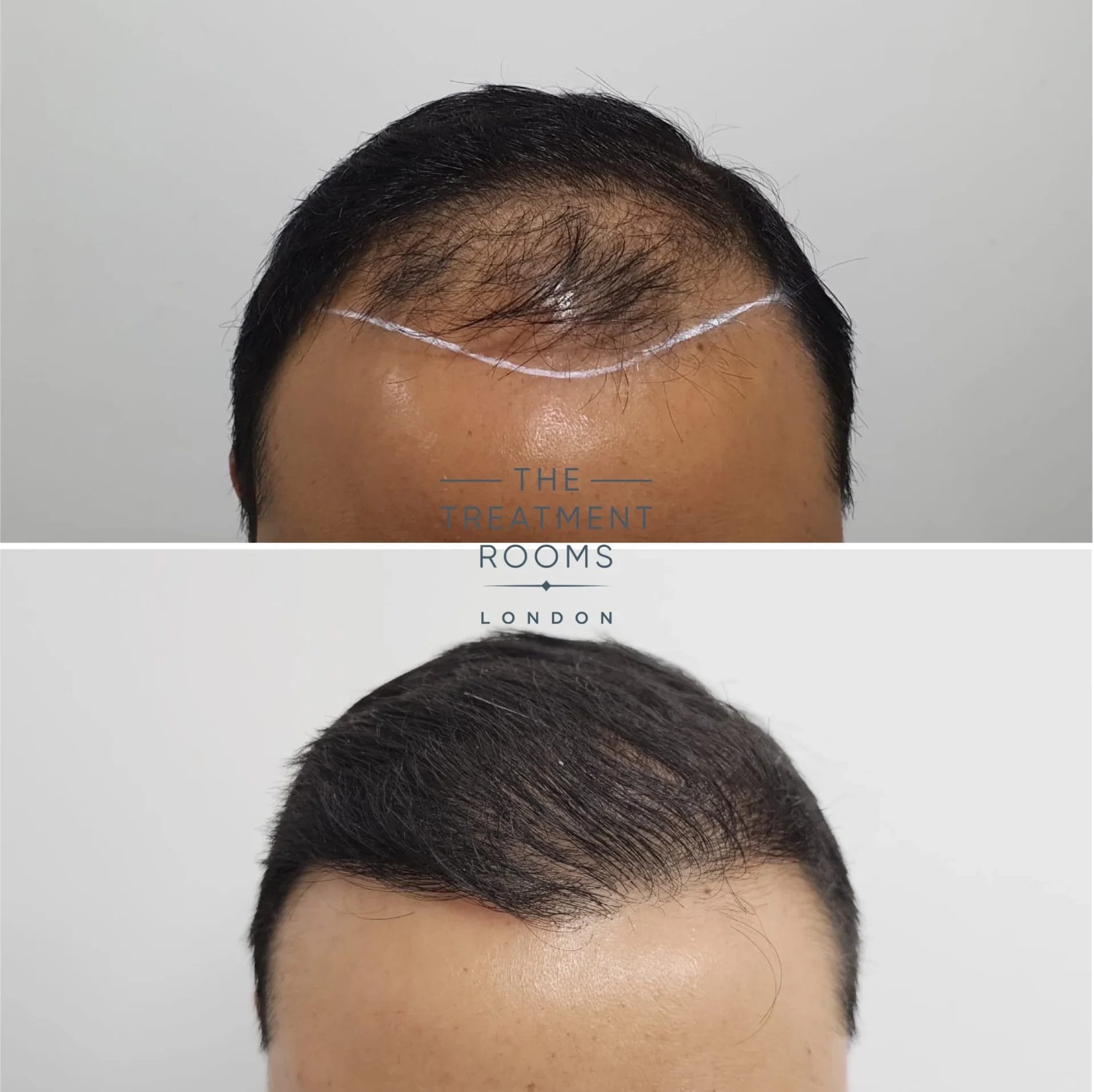 fue hair transplant result 2036 grafts