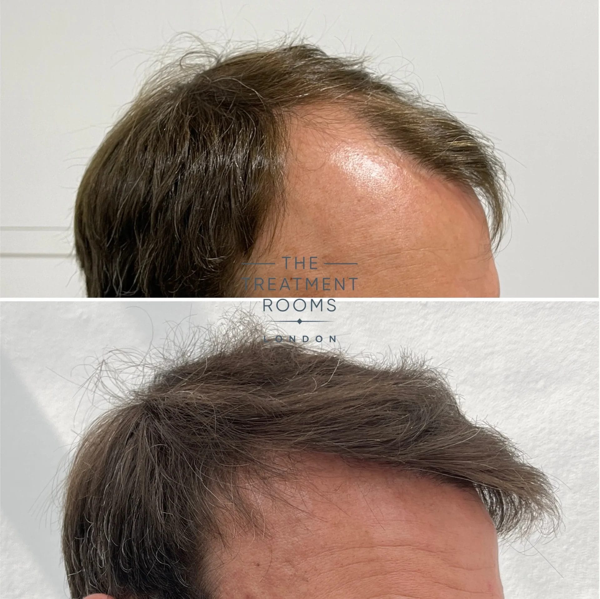 fue transplant 3667 grafts before and after