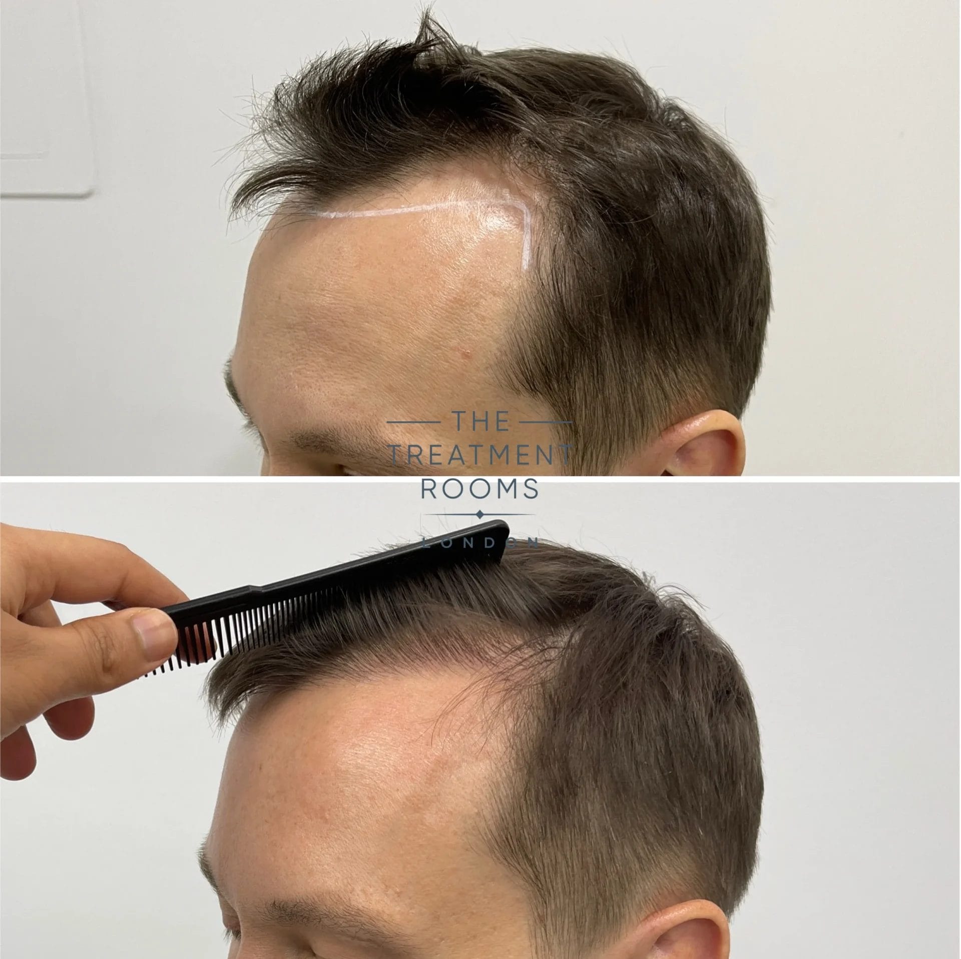 fue transplant hairline result 1402 grafts before and after