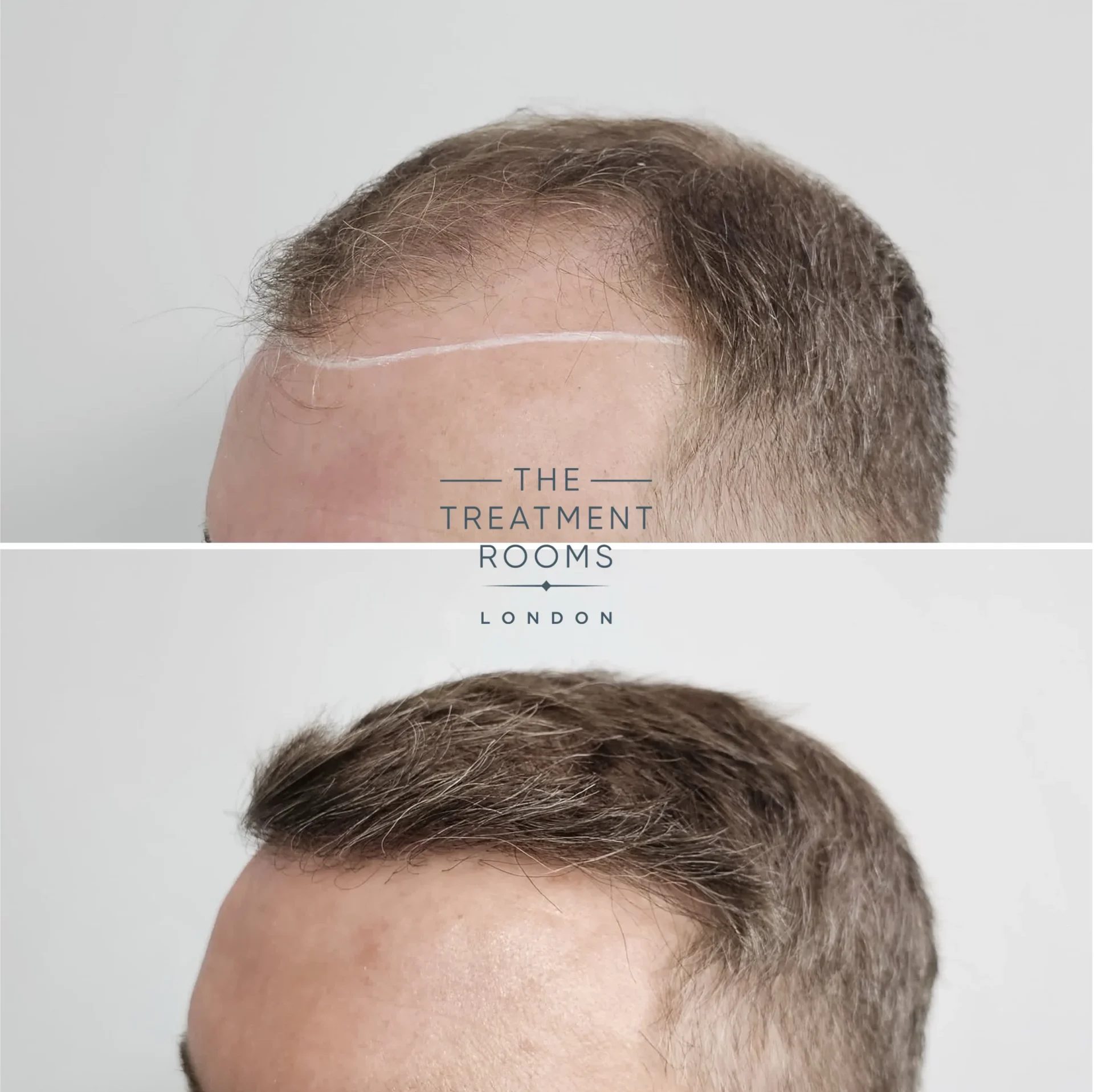 grey hair transplant result