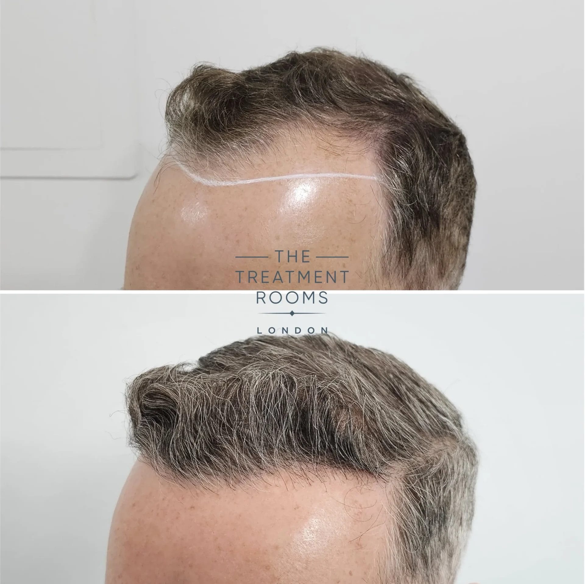 grey hair transplant before and after 1820 grafts