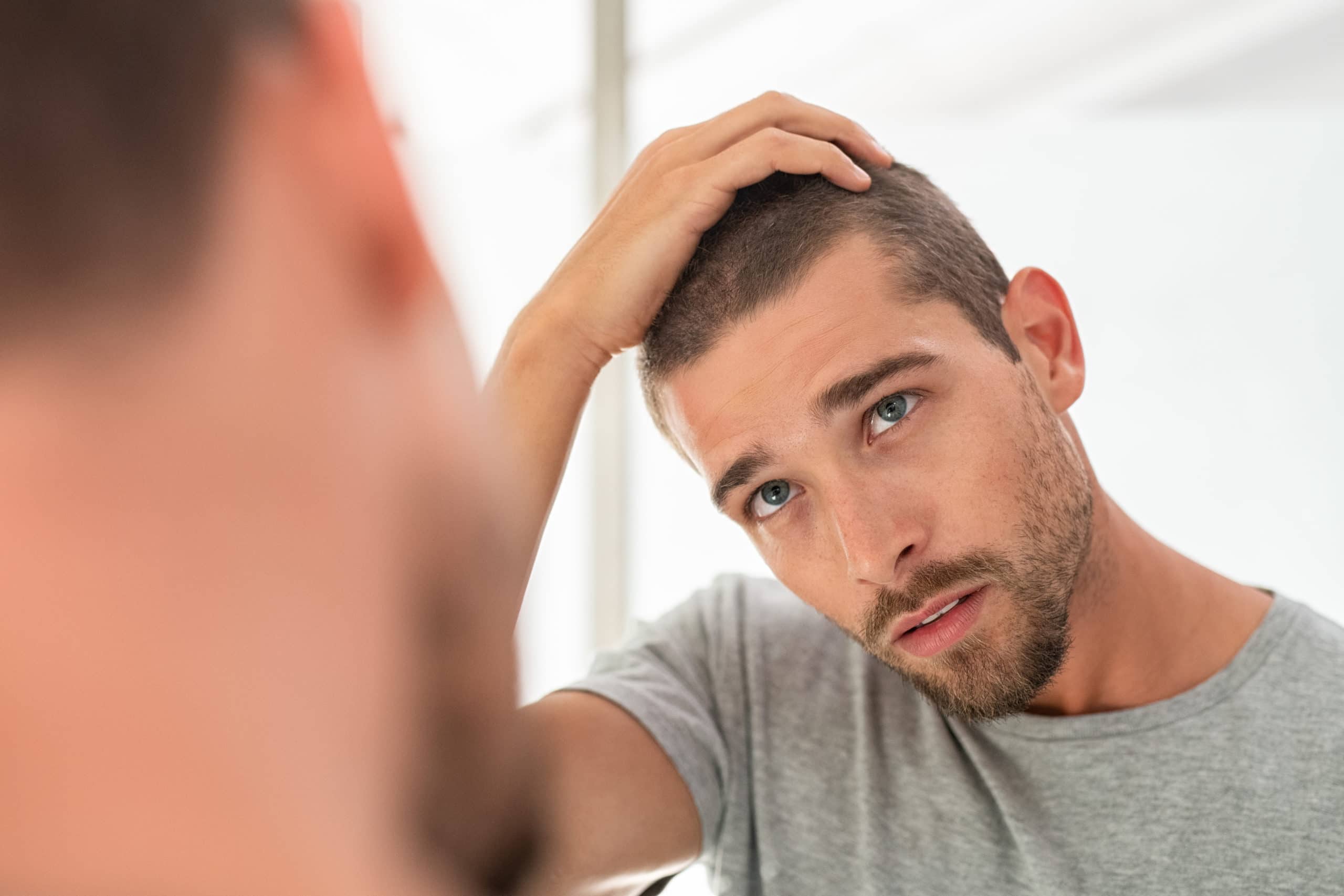 hair loss after hair transplant