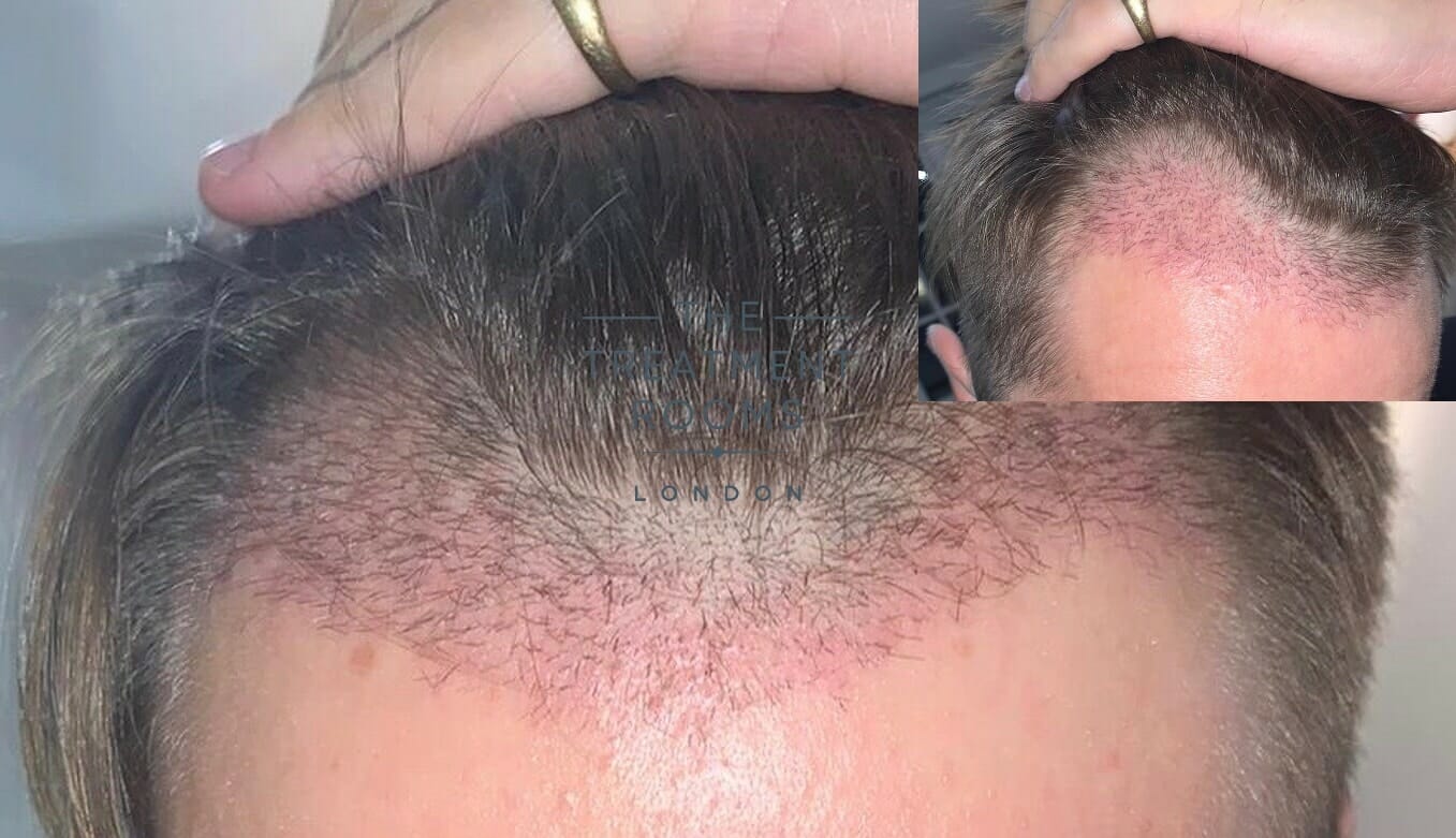 hair shedding 2 weeks post hair transplant